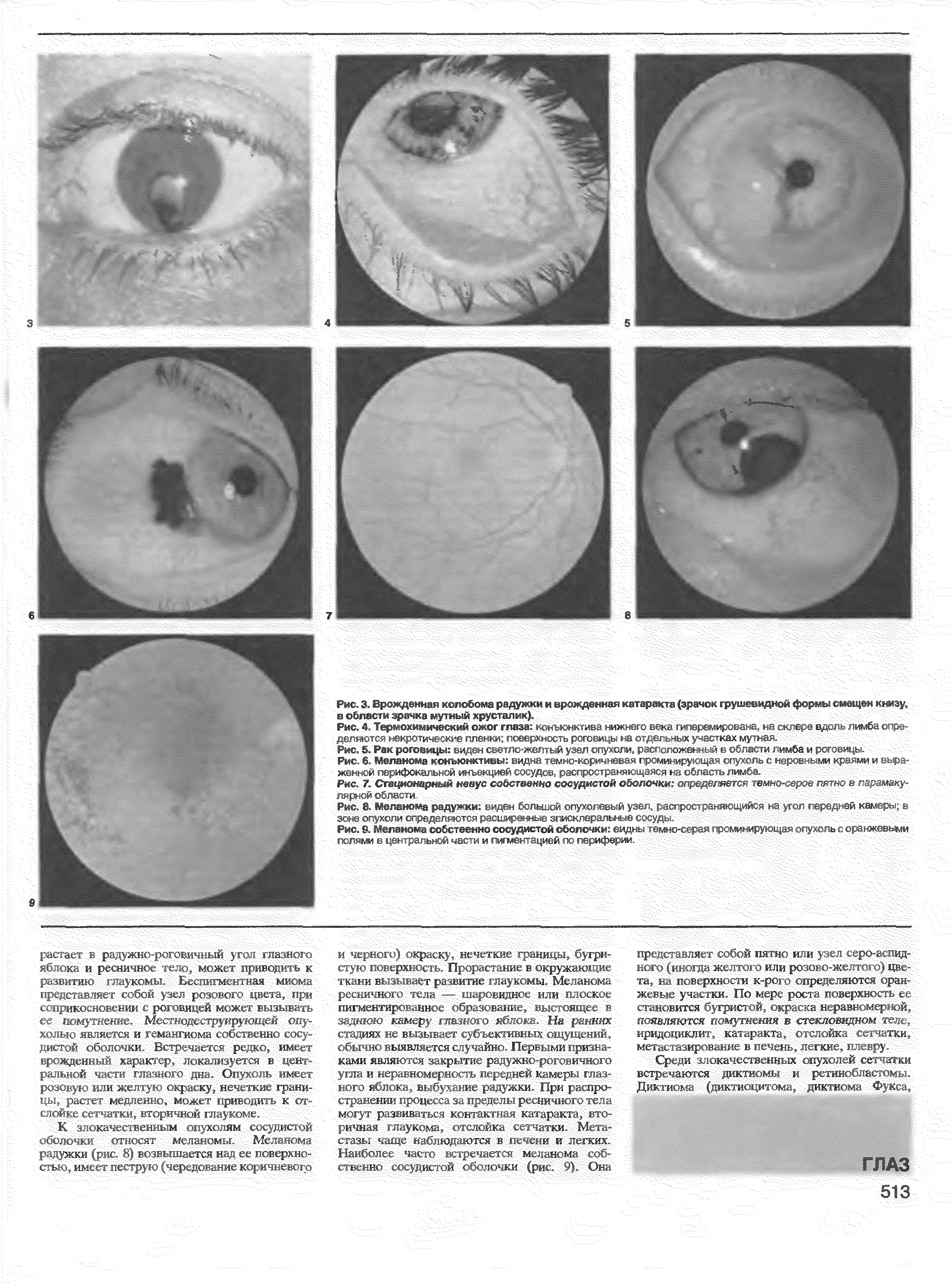 Рис. 7. Стационарный невус собственно сосудистой оболочк ляе < > емки , , , е и < ш лррмой области /...