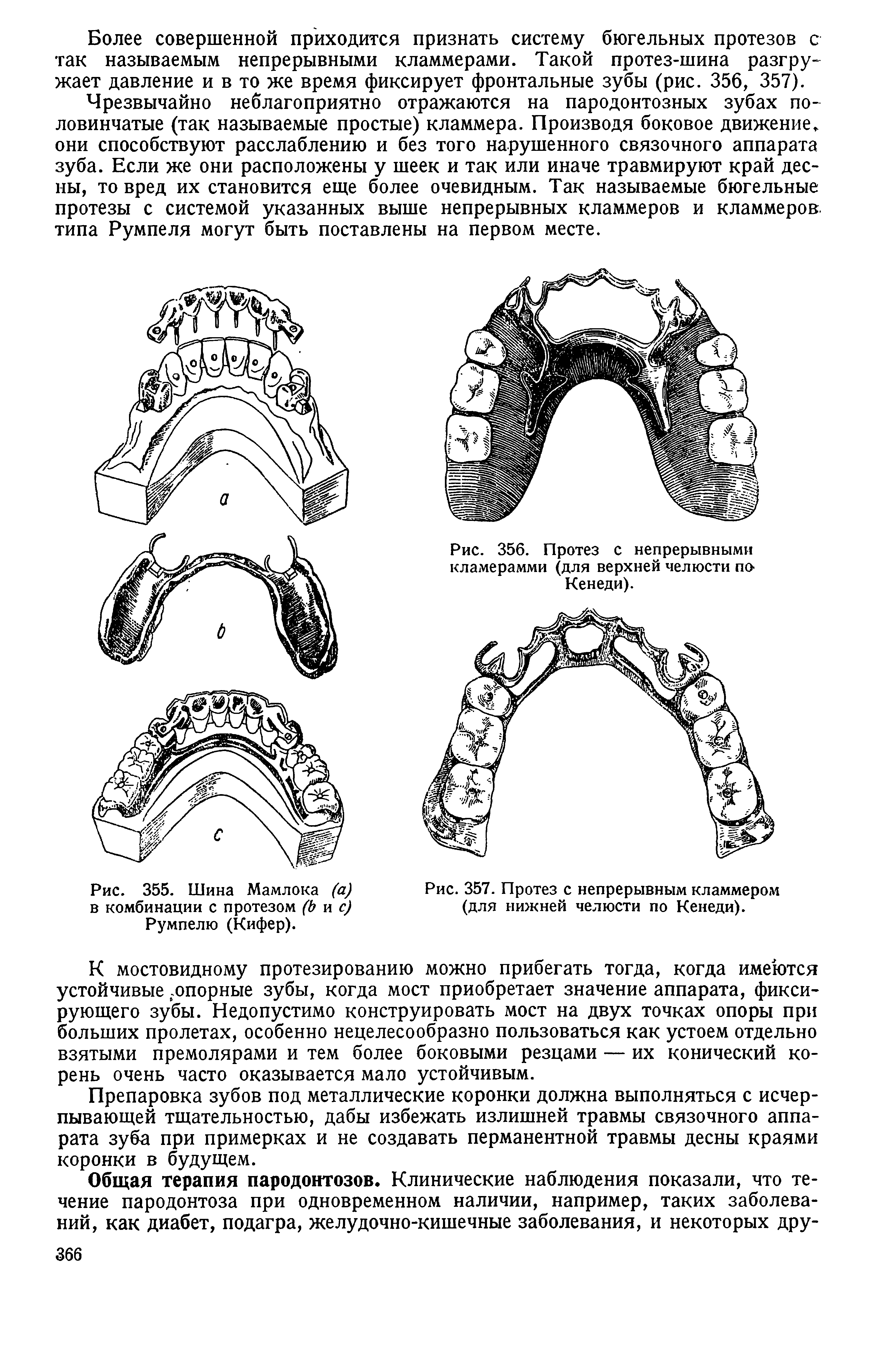 Рис. 355. Шина Мамлока (а) в комбинации с протезом (Ь и с) Румпелю (Кифер).