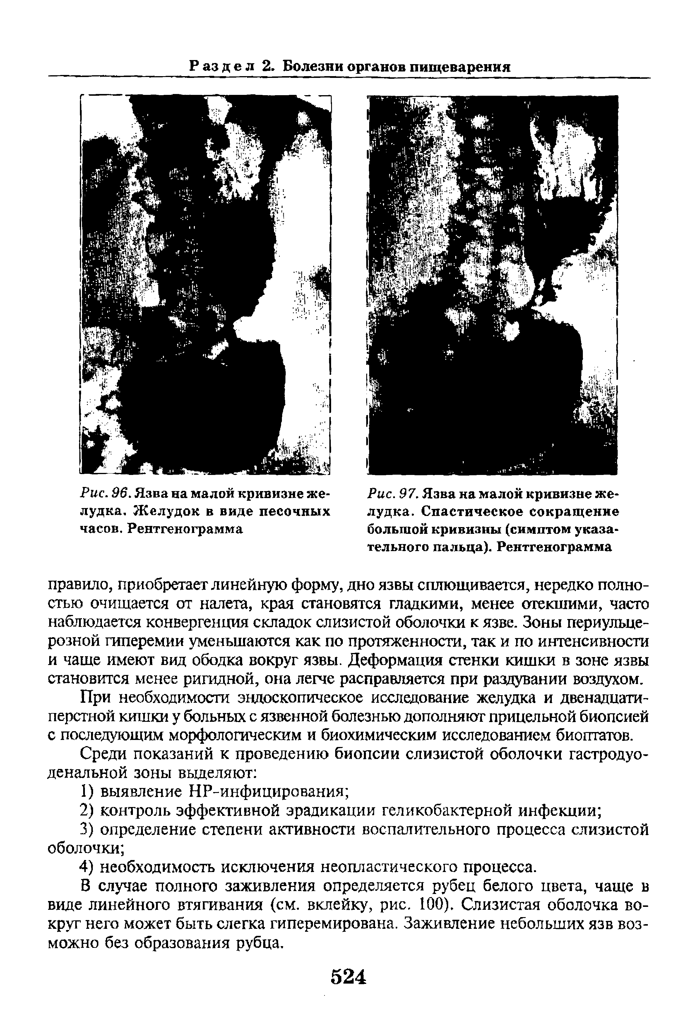 Рис. 97. Язва на малой кривизне желудка. Спастическое сокращение большой кривизны (симптом указательного пальца). Рентгенограмма...