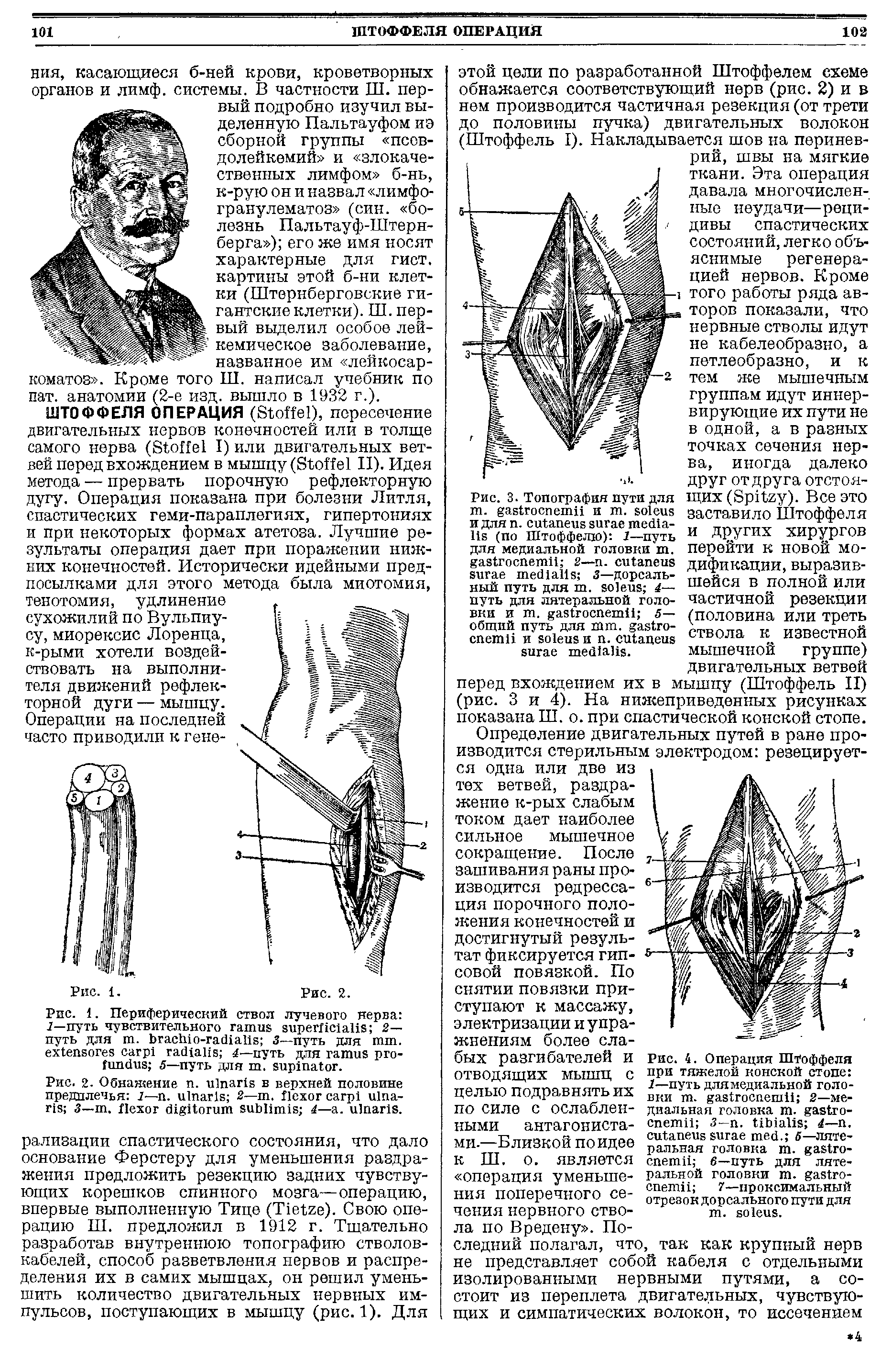 Рис. 4. Операция Штоффеля при тяжелой конской стопе 1—путь длямедиальной головки . 2—медиальная головка т. з— . 4—п. . —литеральная головка т. 6—путь для литеральной головки . 7—проксимальный...