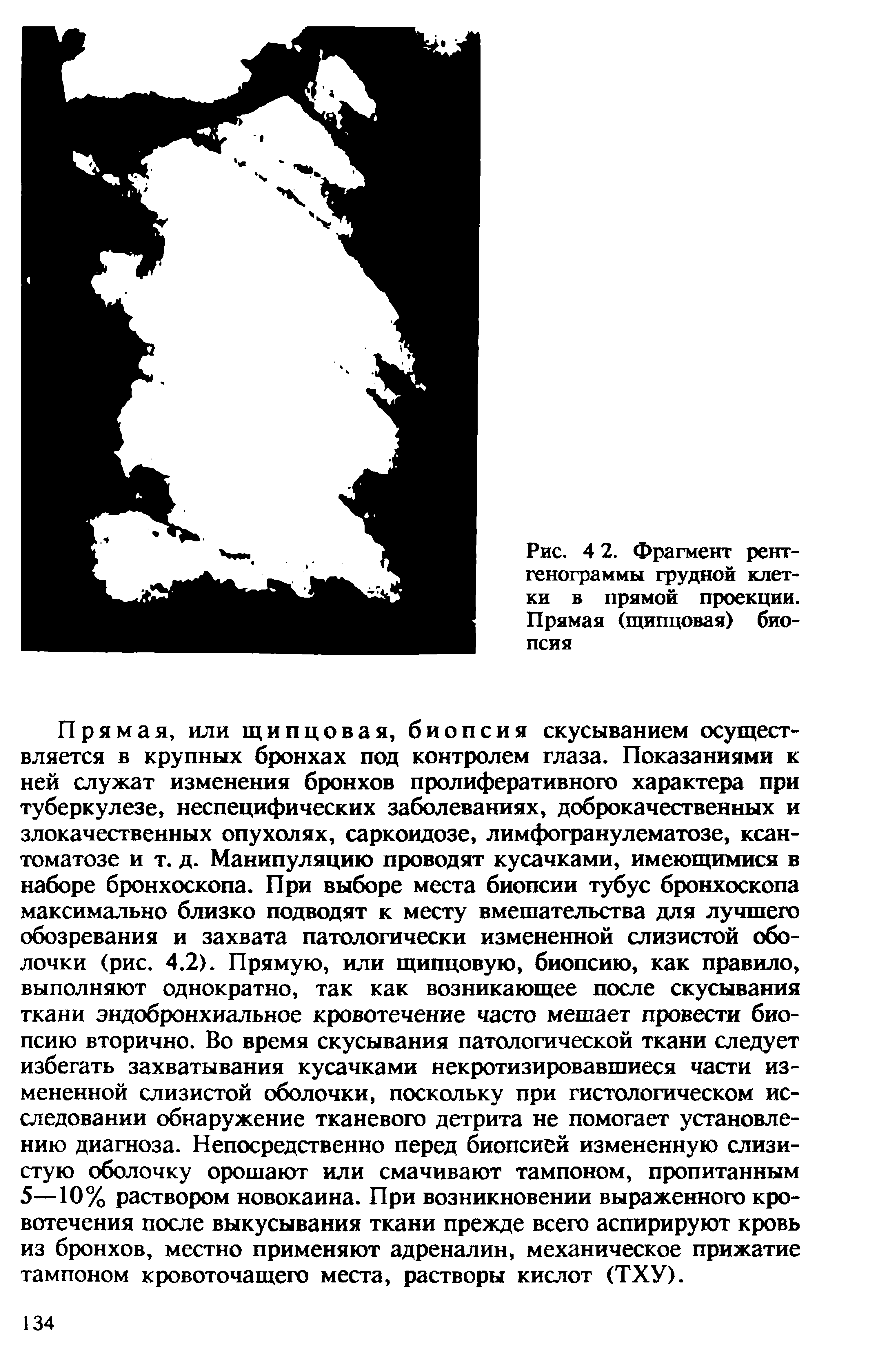 Рис. 4 2. Фрагмент рентгенограммы грудной клетки в прямой проекции. Прямая (щипцовая) биопсия...