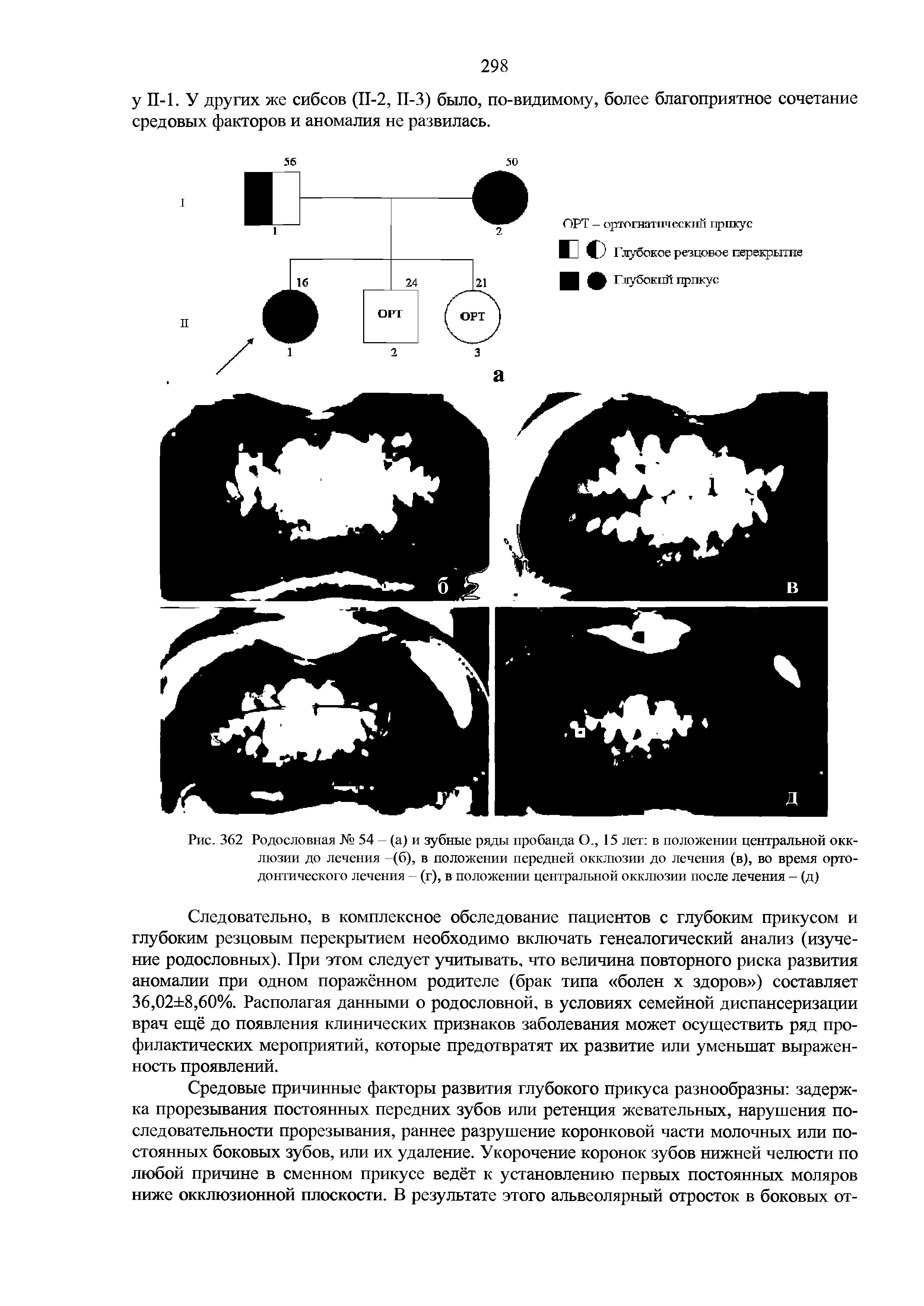 Рис. 362 Родословная № 54 - (а) и зубные ряды пробанда О., 15 лет в положении центральной окклюзии до лечения —(б), в положении передней окклюзии до лечения (в), во время ортодонтического лечения - (г), в положении центральной окклюзии после лечения - (д)...