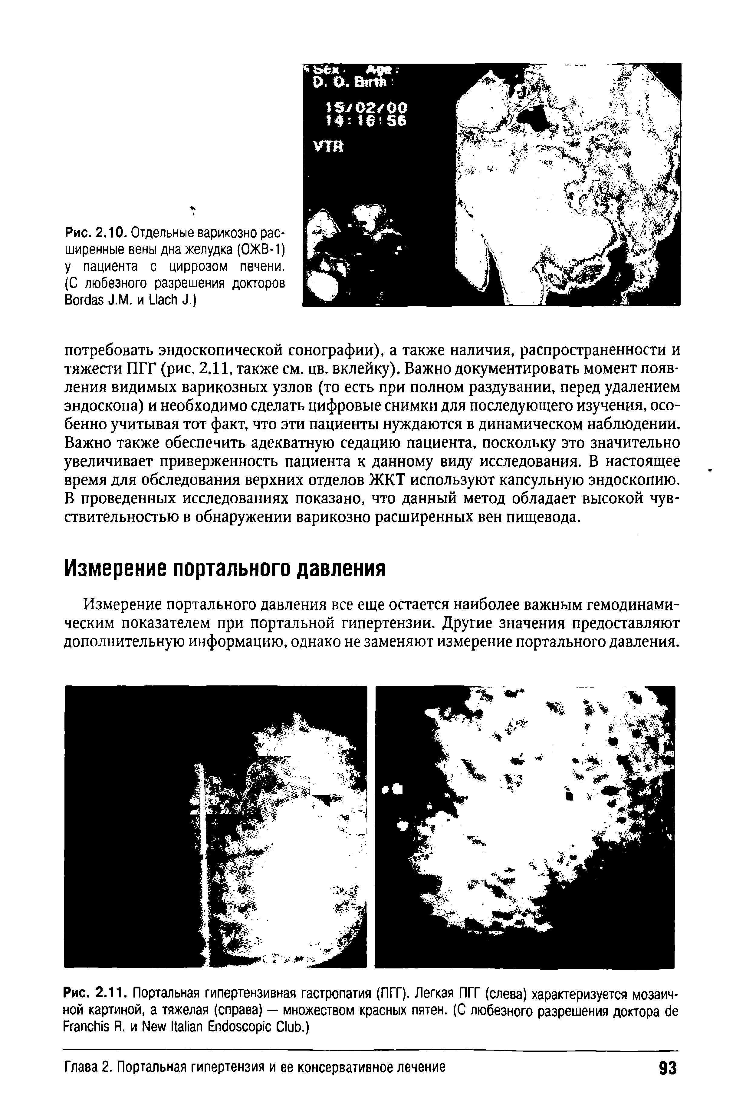 Рис. 2.11. Портальная гипертензивная гастропатия (ПГГ). Легкая ПГГ (слева) характеризуется мозаичной картиной, а тяжелая (справа) — множеством красных пятен. (С любезного разрешения доктора F R. и N I E C .)...