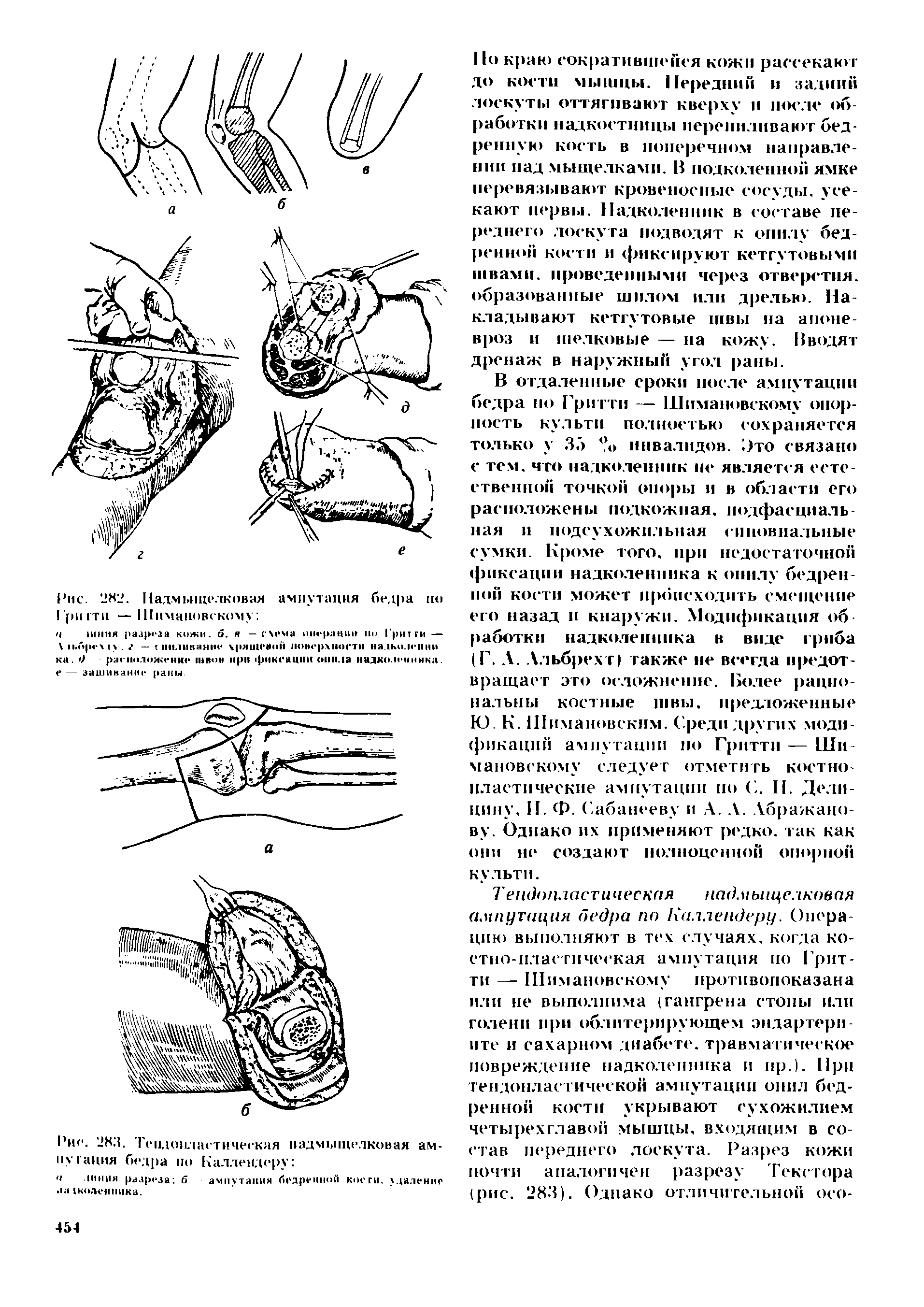 Рис. 283. Тепдо ыастическяя надмыщелковая ампутация бедра по Каллендеру ...