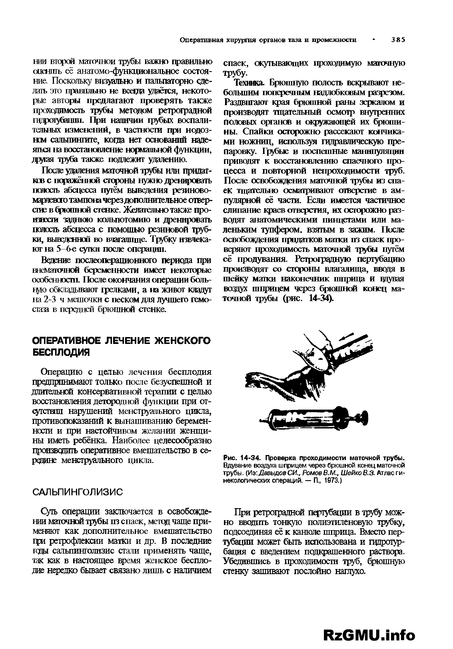 Рис. 14-34. Проверка проходимости маточной трубы. Вдувание воздуха шприцем через брюшной конец маточной трубы. (Из Давыдов СИ., РомовВ.М., ШейкоВ.З. Атлас гинекологических операций. — П, 1973.)...