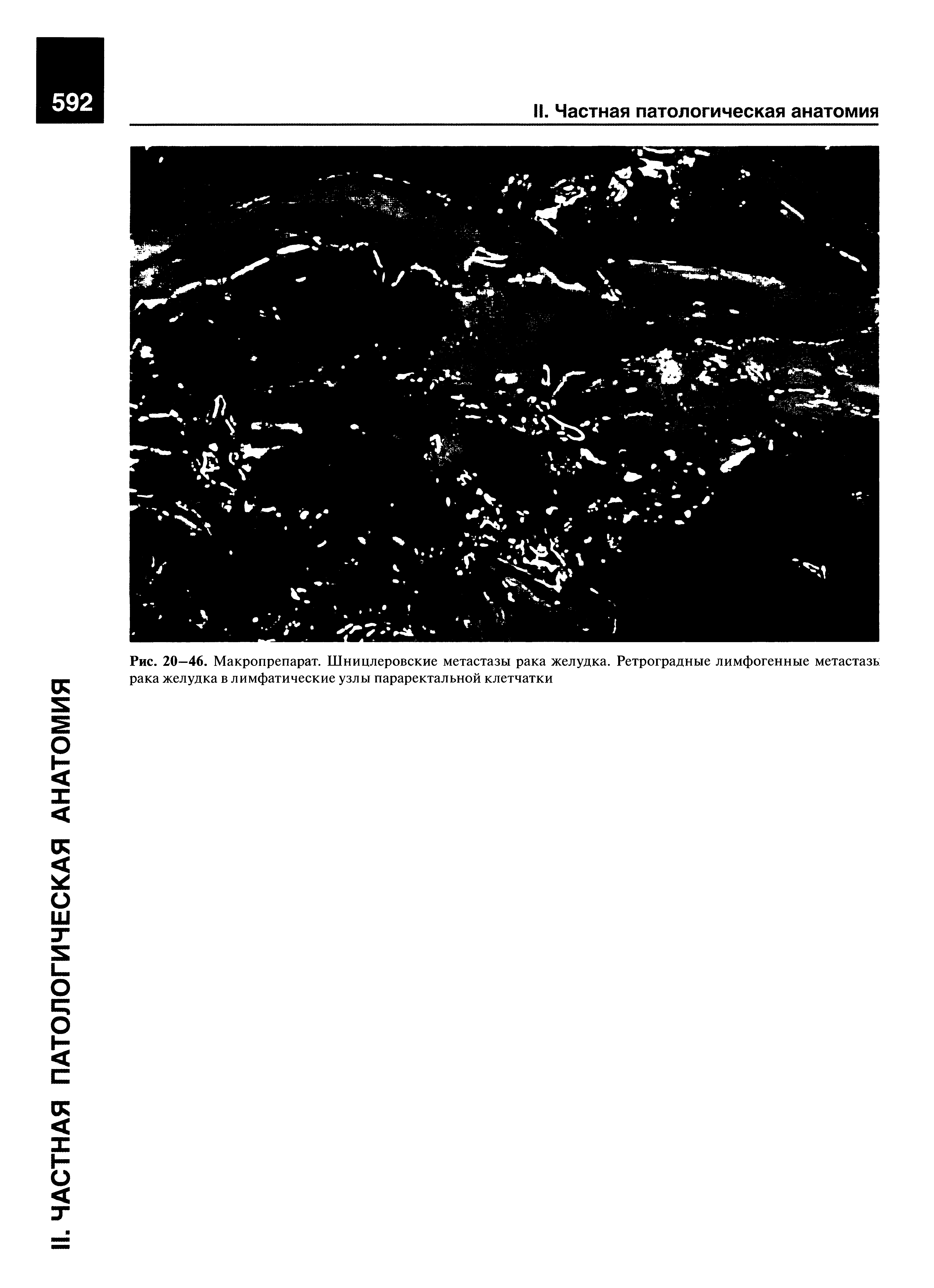 Рис. 20—46. Макропрепарат. Шницлеровские метастазы рака желудка. Ретроградные лимфогенные метастазь рака желудка в лимфатические узлы параректальной клетчатки...