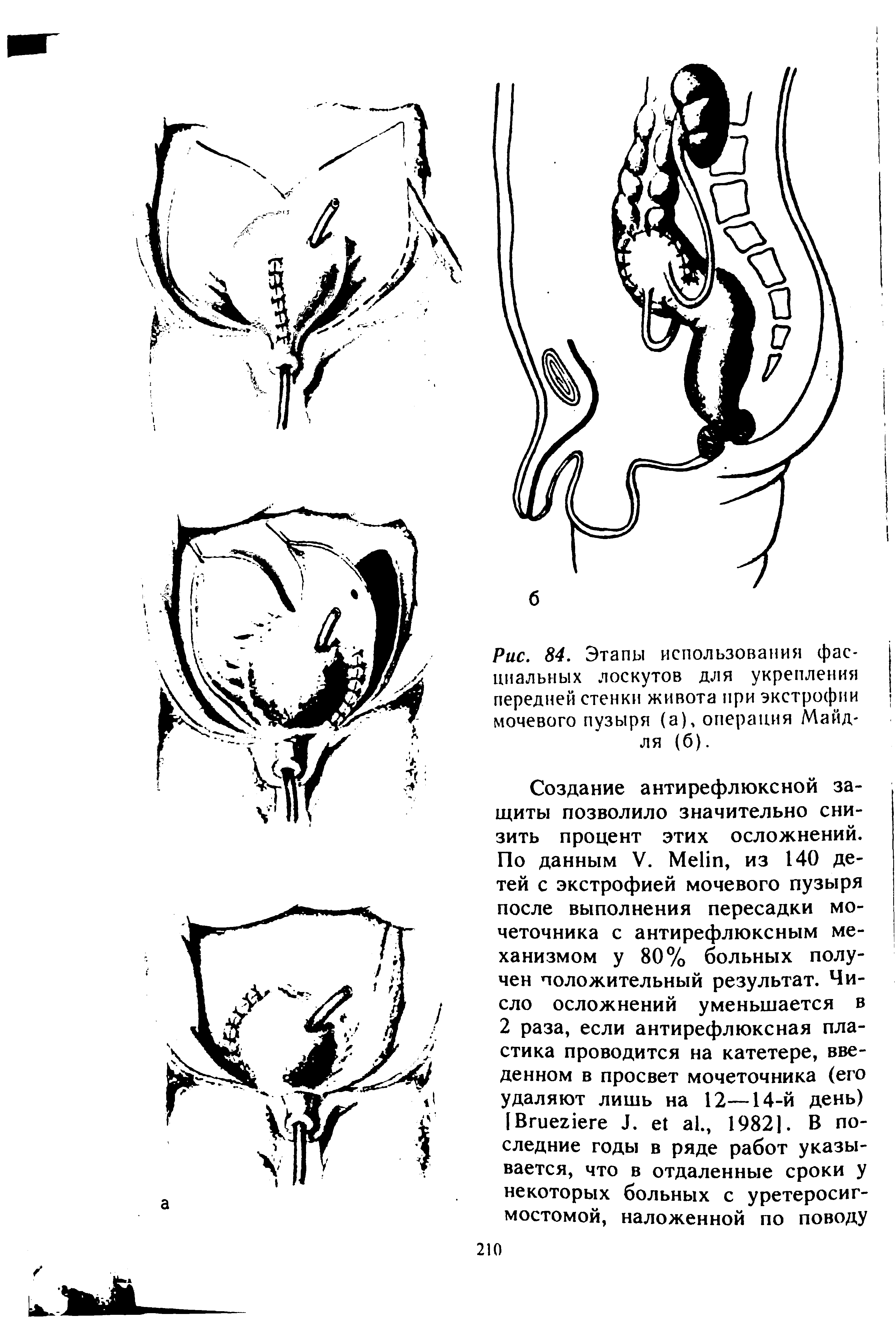 Рис. 84. Этапы использования фасциальных лоскутов для укрепления передней стенки живота при экстрофии мочевого пузыря (а), операция Майд-ля (б).