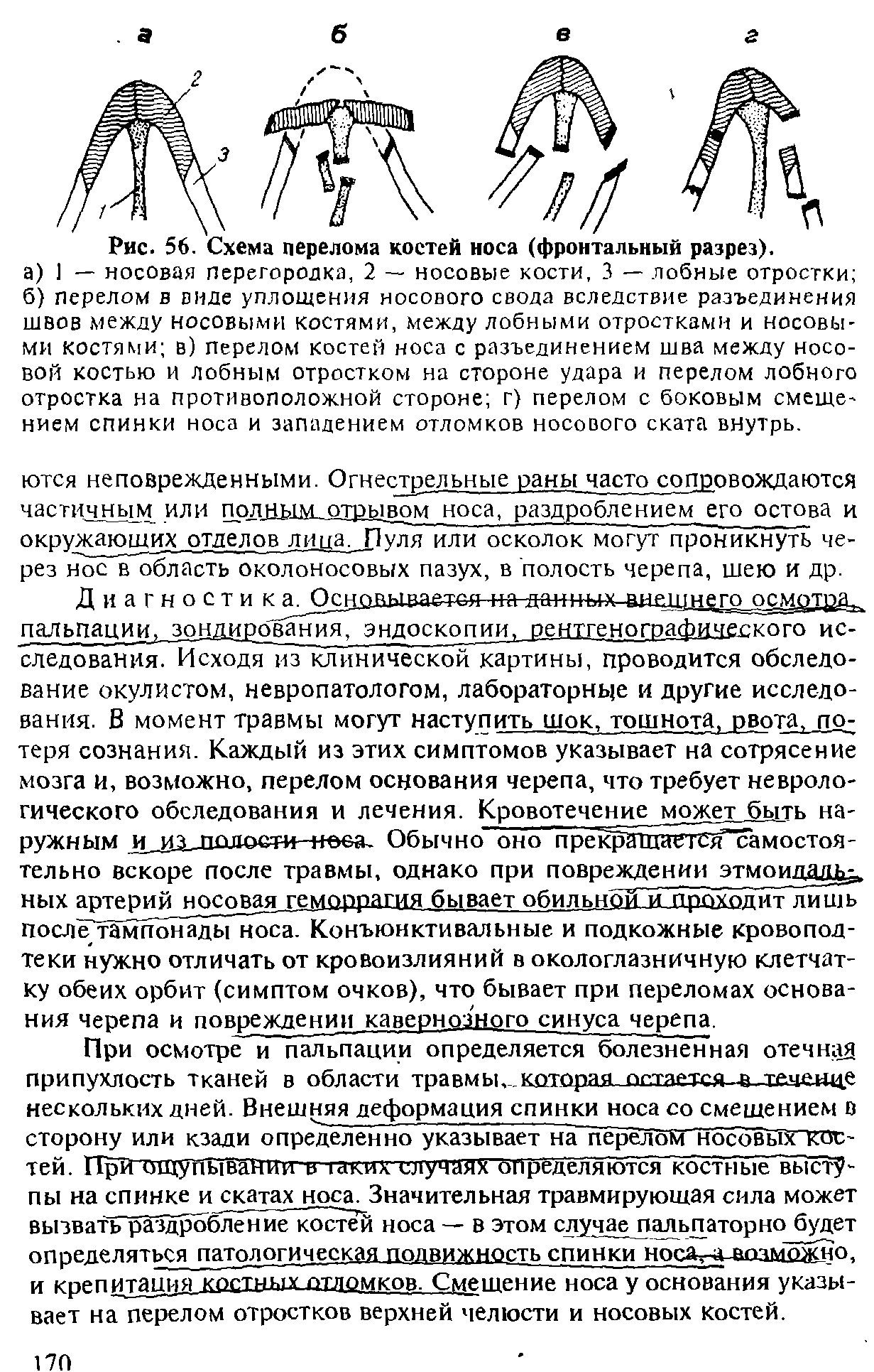 Рис. 56. Схема перелома костей носа (фронтальный разрез).