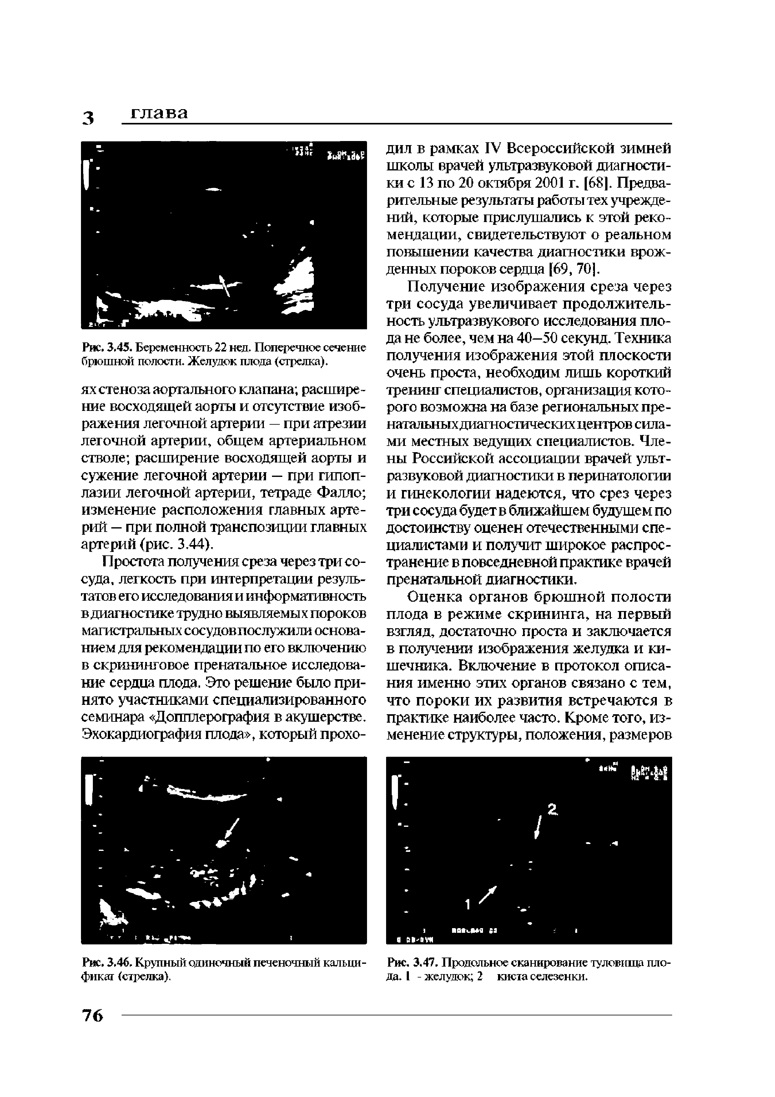 Рис. 3.45. Беременность 22 нед. Поперечное сечение брюшной полости. Желудок плода (стрелка).