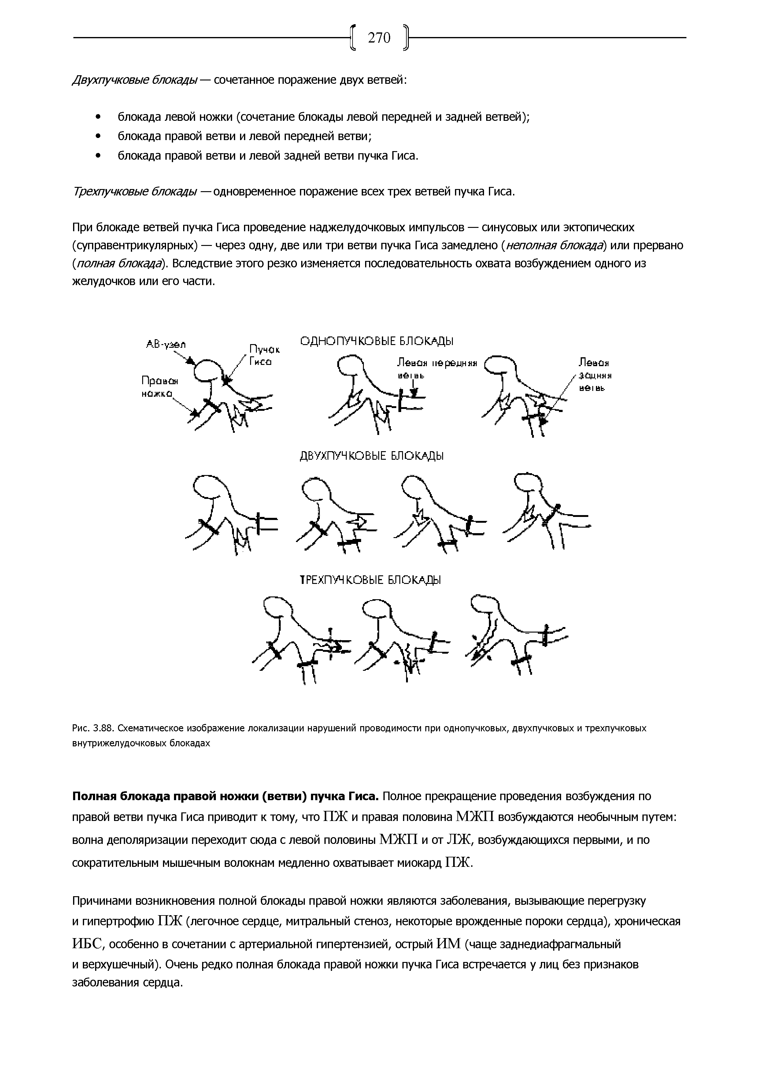 Рис. 3.88. Схематическое изображение локализации нарушений проводимости при однопучковых, двухпучковых и трехпучковых внутрижелудочковых блокадах...