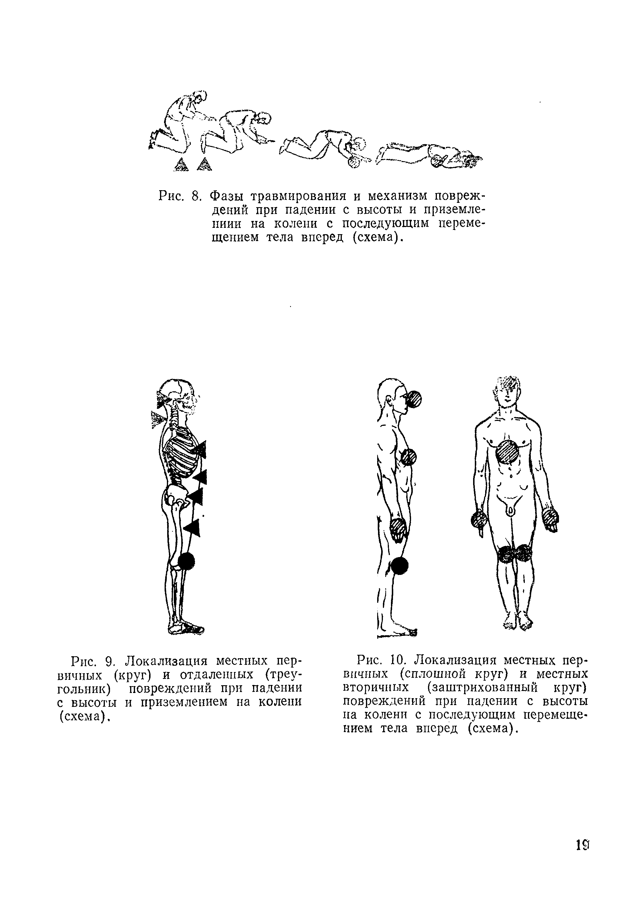 Рис. 9. Локализация местных первичных (круг) и отдаленных (треугольник) повреждений при падении с высоты и приземлением на колени (схема).