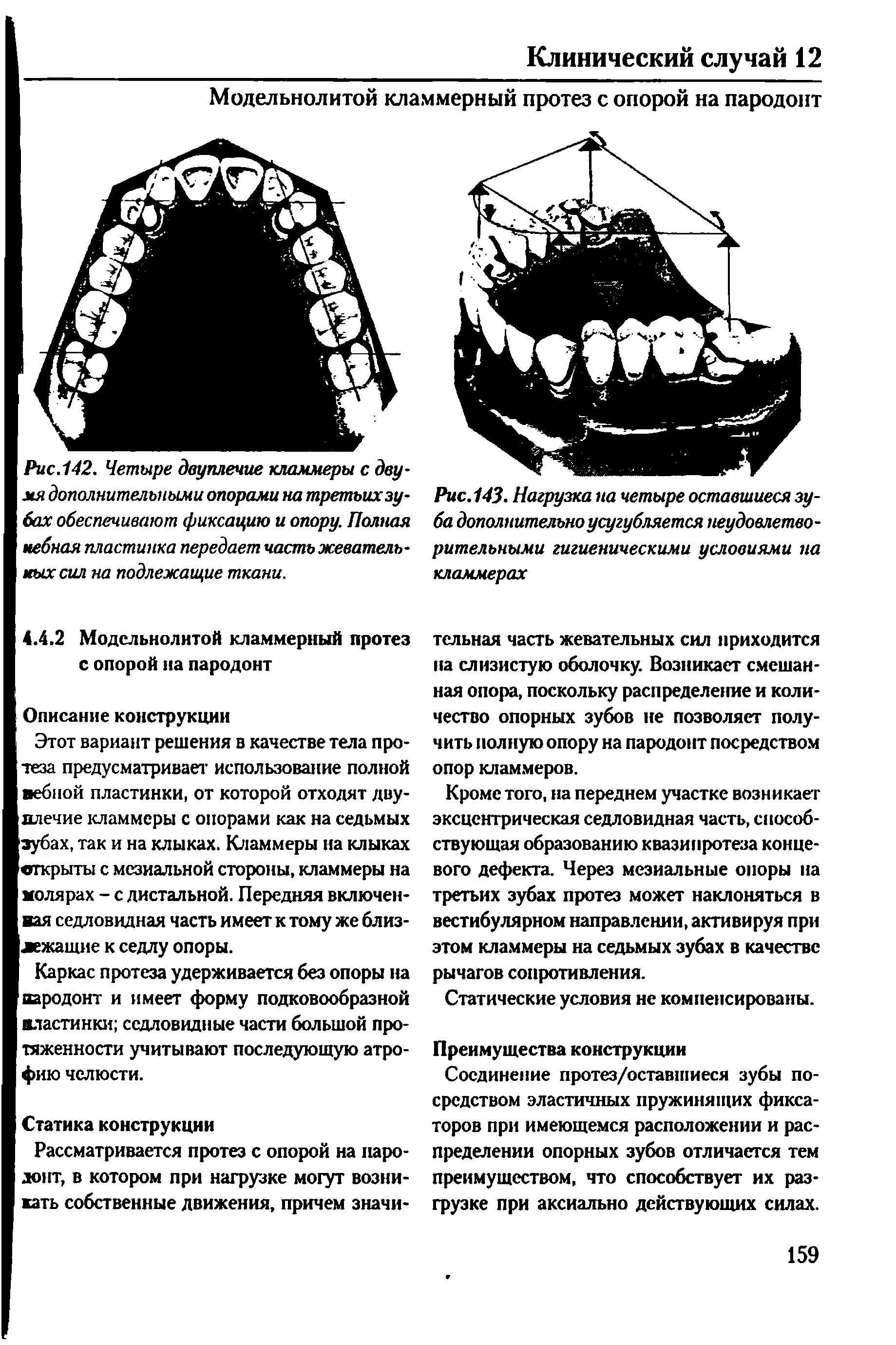 Рис.142. Четыре двуплечие кламмеры с двумя дополнительными опорами на третьих зубах обеспечивают фиксацию и опору. Полная небная пластинка передает часть жевательных сил на подлежащие ткани.