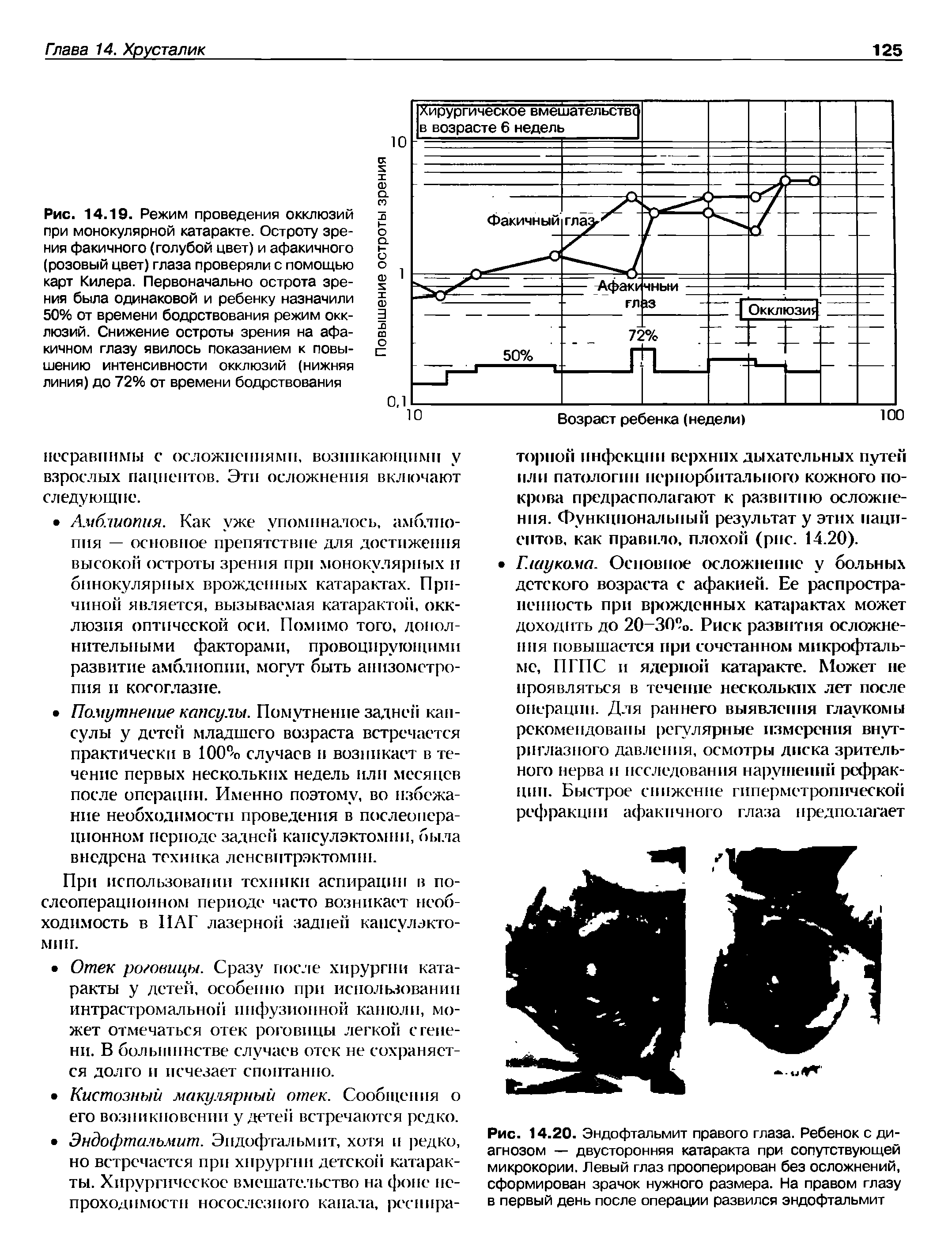 Рис. 14.20. Эндофтальмит правого глаза. Ребенок с диагнозом — двусторонняя катаракта при сопутствующей микрокории. Левый глаз прооперирован без осложнений, сформирован зрачок нужного размера. На правом глазу в первый день после операции развился эндофтальмит...