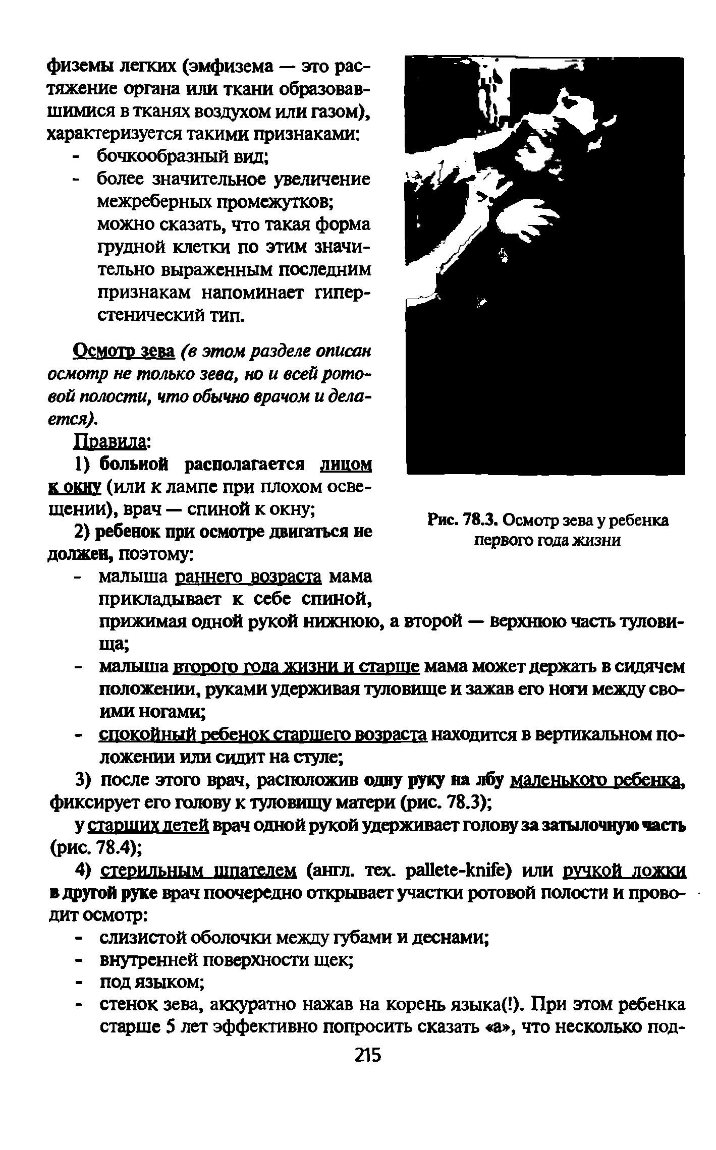 Рис. 78.3. Осмотр зева у ребенка первого года жизни...