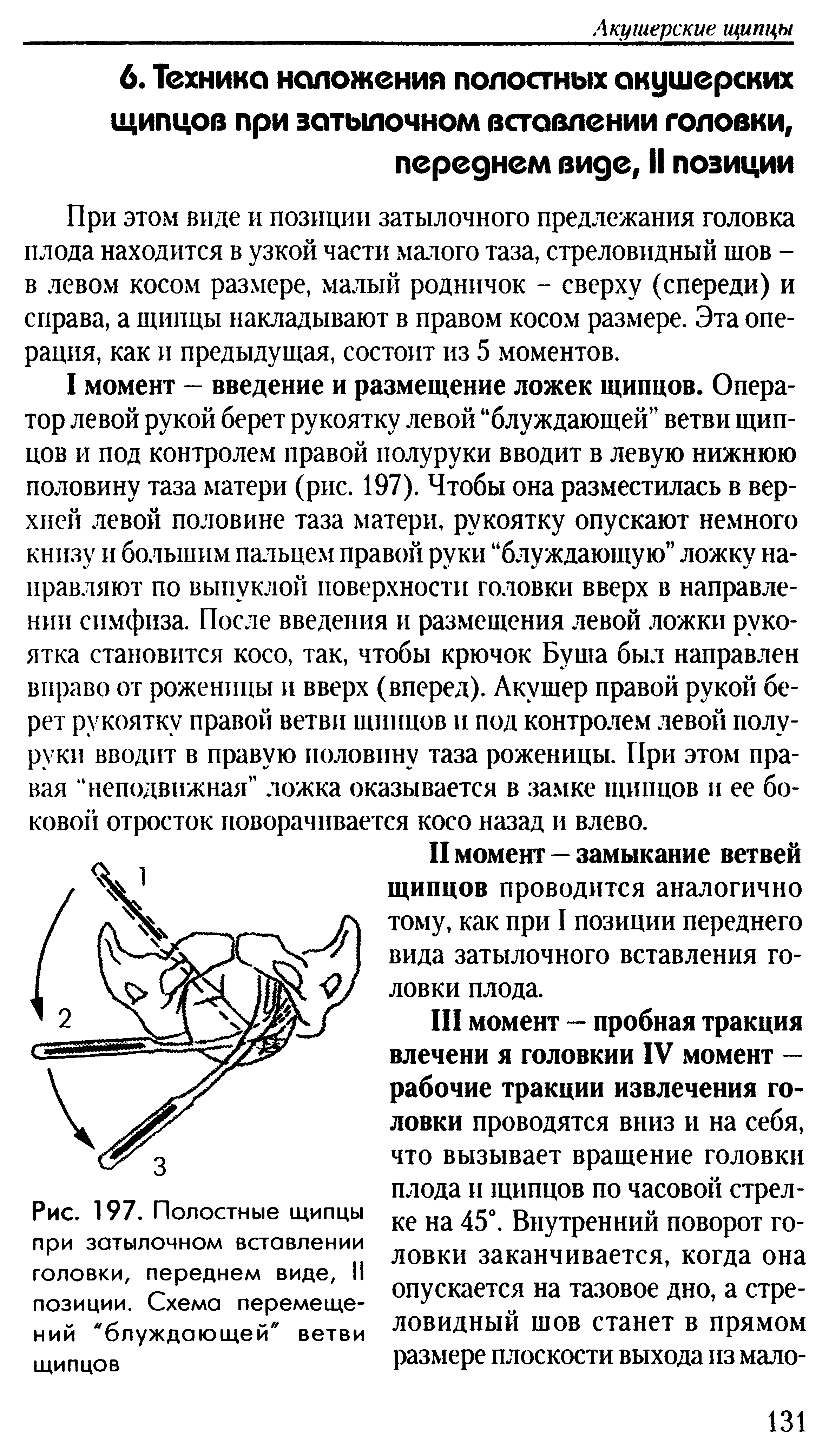 Рис. 197. Полостные щипцы при затылочном вставлении головки, переднем виде, II позиции. Схема перемещений "блуждающей" ветви...