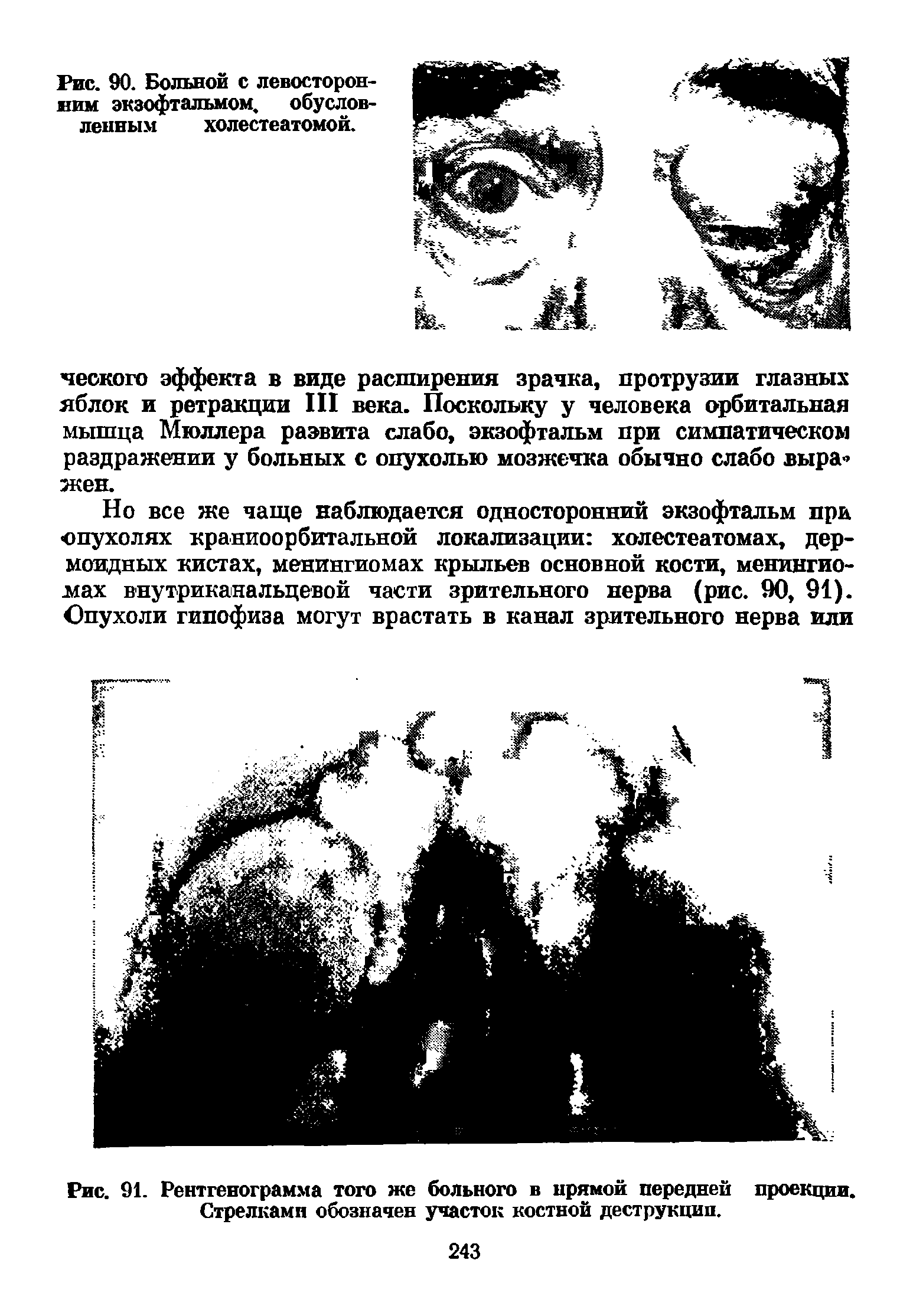 Рис. 91. Рентгенограмма того же больного в прямой передней проекции. Стрелками обозначен участок костной деструкции.