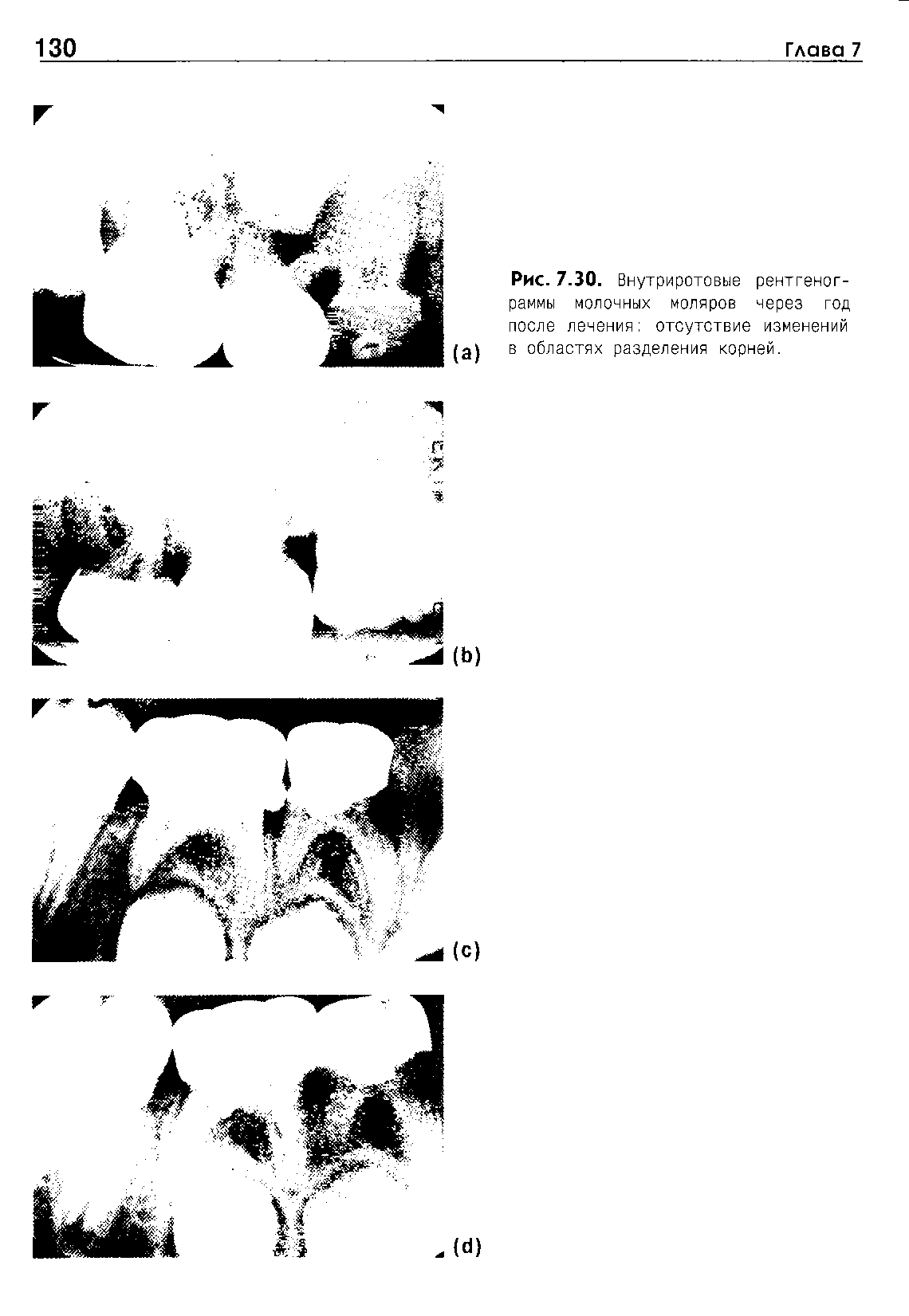 Рис. 7.30. Внутриротовые рентгенограммы молочных моляров через год после лечения отсутствие изменений в областях разделения корней.