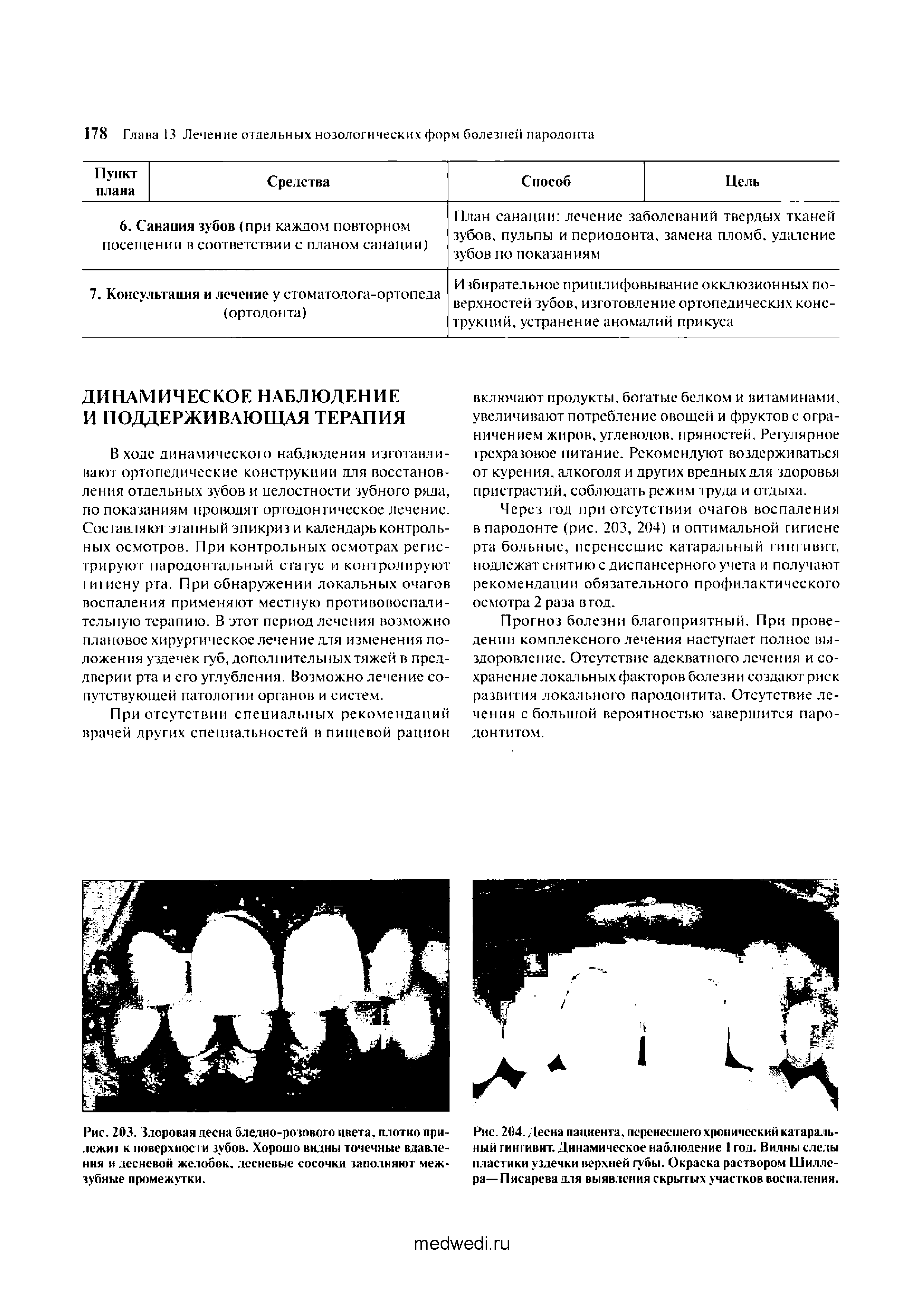 Рис. 204. Десна пациента, перенесшего хронический катаральный гингивит. Динамическое наблюдение 1 год. Видны следы пластики уздечки верхней губы. Окраска раствором Шиллера— Писарева для выявления скрытых участков воспаления.