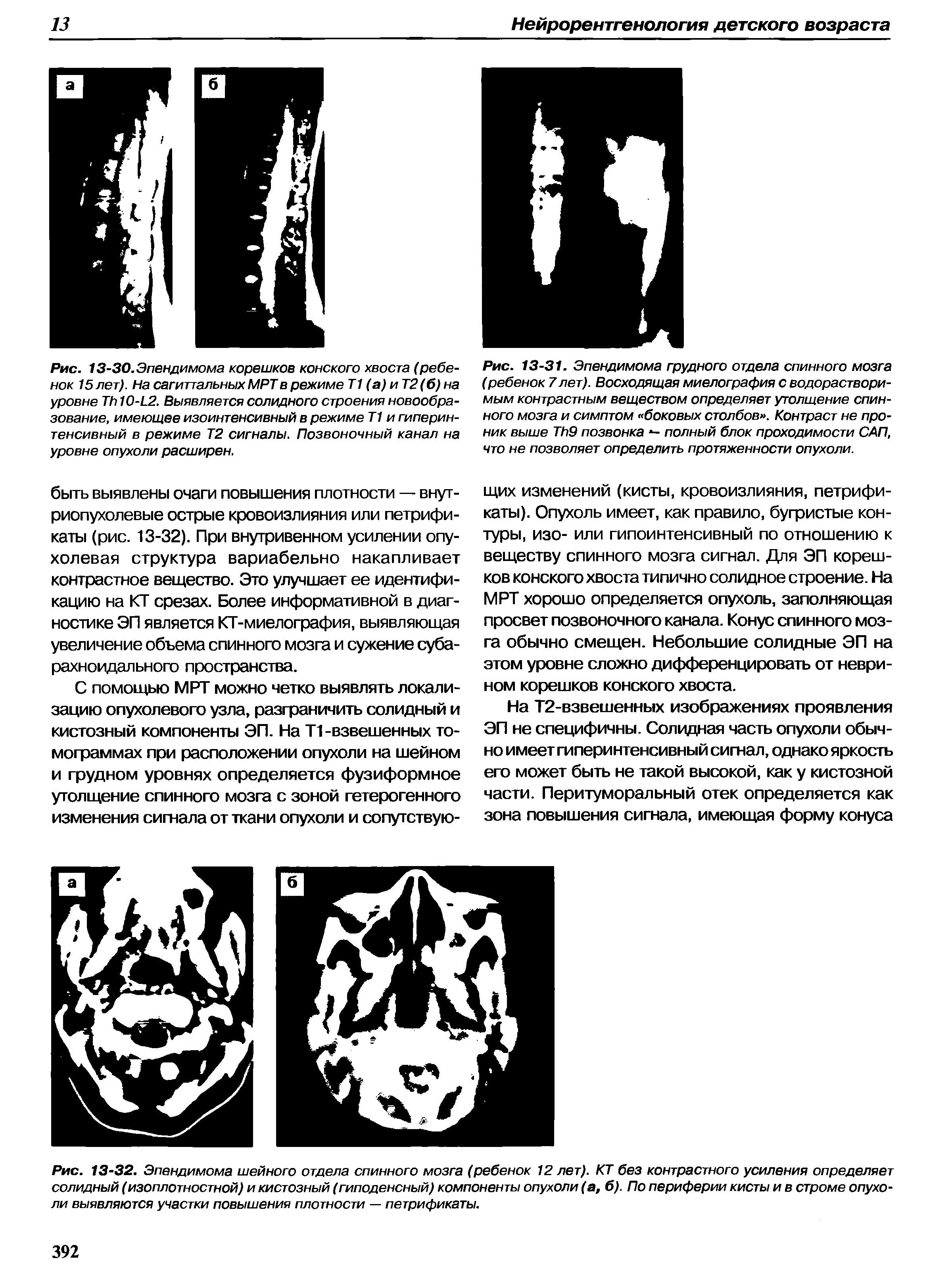 Рис. 13-31. Эпендимома грудного отдела спинного мозга (ребенок 7лет). Восходящая миелография с водорастворимым контрастным веществом определяет утолщение спинного мозга и симптом боковых столбов . Контраст не проник выше Тб9 позвонка - полный блок проходимости САП, что не позволяет определить протяженности опухоли.