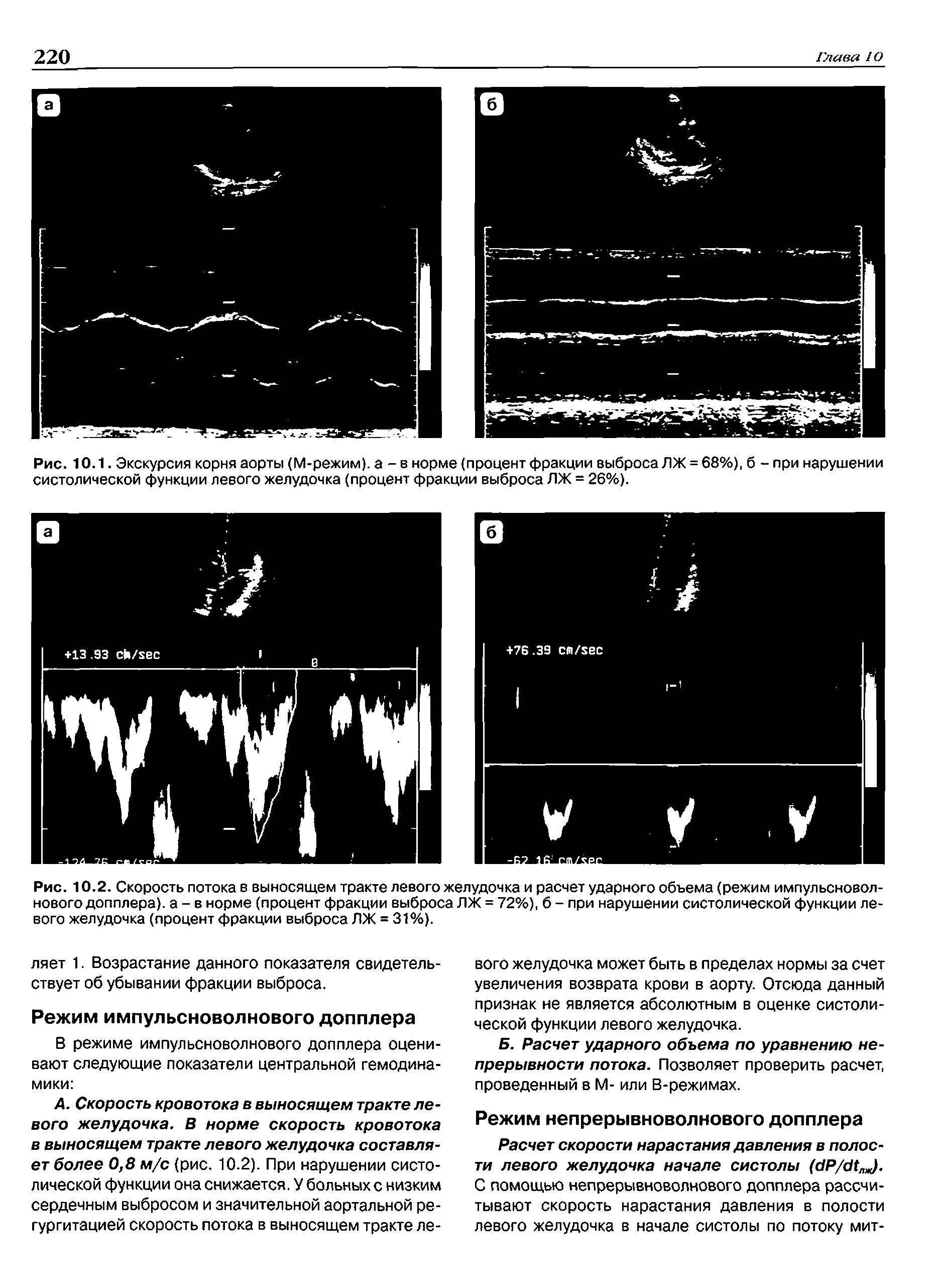 Рис. 10.2. Скорость потока в выносящем тракте левого желудочка и расчет ударного объема (режим импульсноволнового допплера), а - в норме (процент фракции выброса ЛЖ = 72%), б - при нарушении систолической функции левого желудочка (процент фракции выброса ЛЖ = 31%).