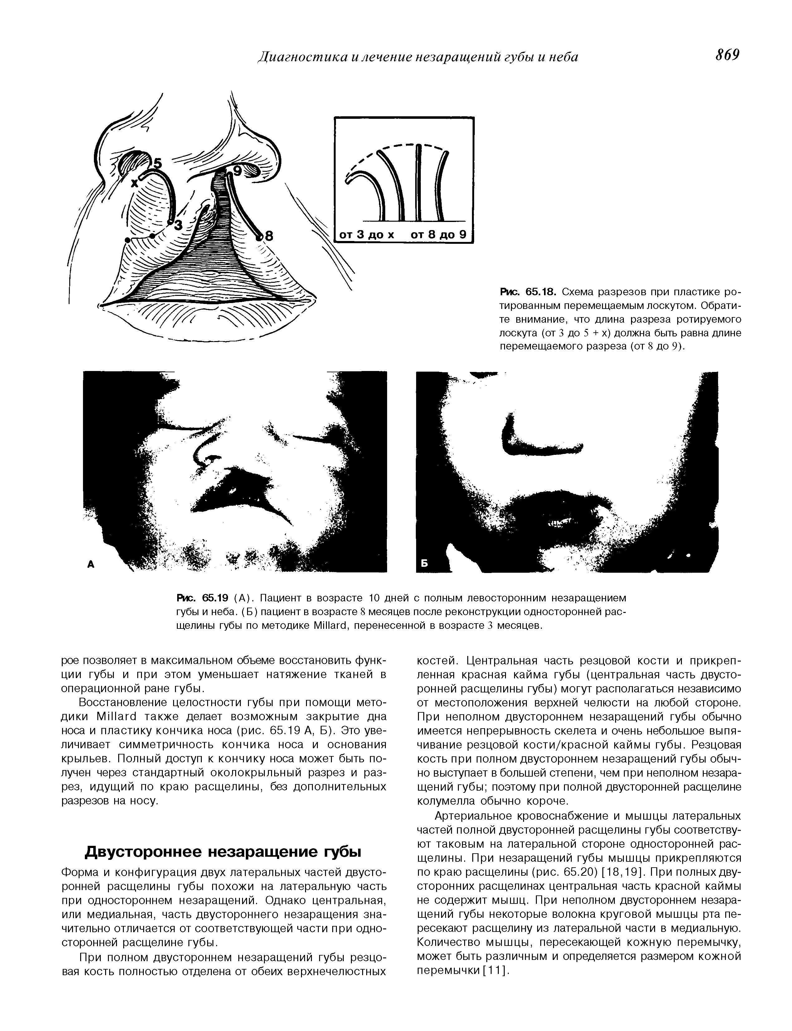 Рис. 65.19 (А). Пациент в возрасте 10 дней с полным левосторонним незаращением губы и неба. (Б) пациент в возрасте 8 месяцев после реконструкции односторонней расщелины губы по методике M , перенесенной в возрасте 3 месяцев.