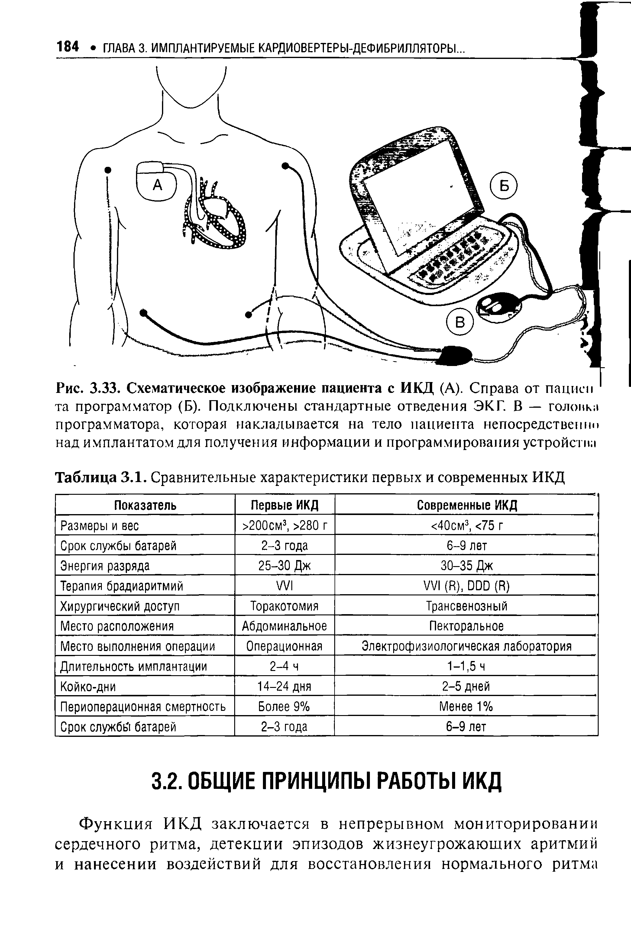 Рис. 3.33. Схематическое изображение пациента с ИКД (А). Справа от пациеп та программатор (Б). Подключены стандартные отведения ЭКГ. В — головки программатора, которая накладывается на тело пациента непосредственно над имплантатом для получения информации и программирования устройств ...