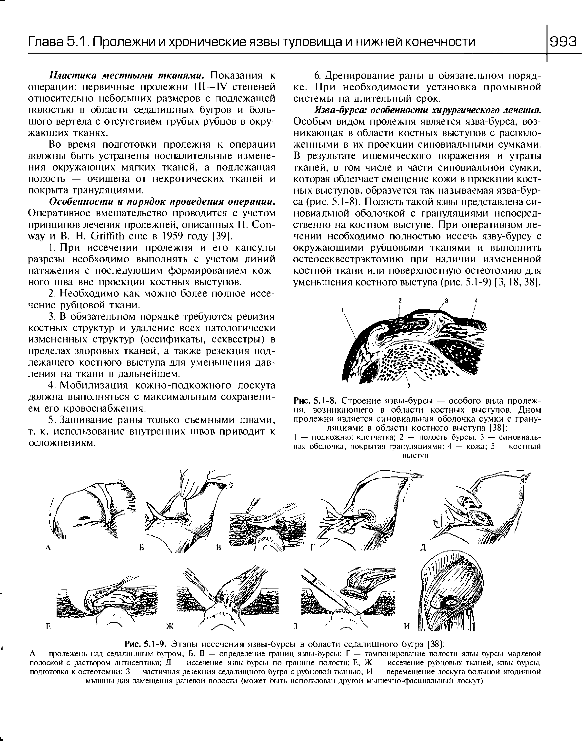 Рис. 5.1-9. Этапы иссечения язвы-бурсы в области седалищного бугра [38] ...