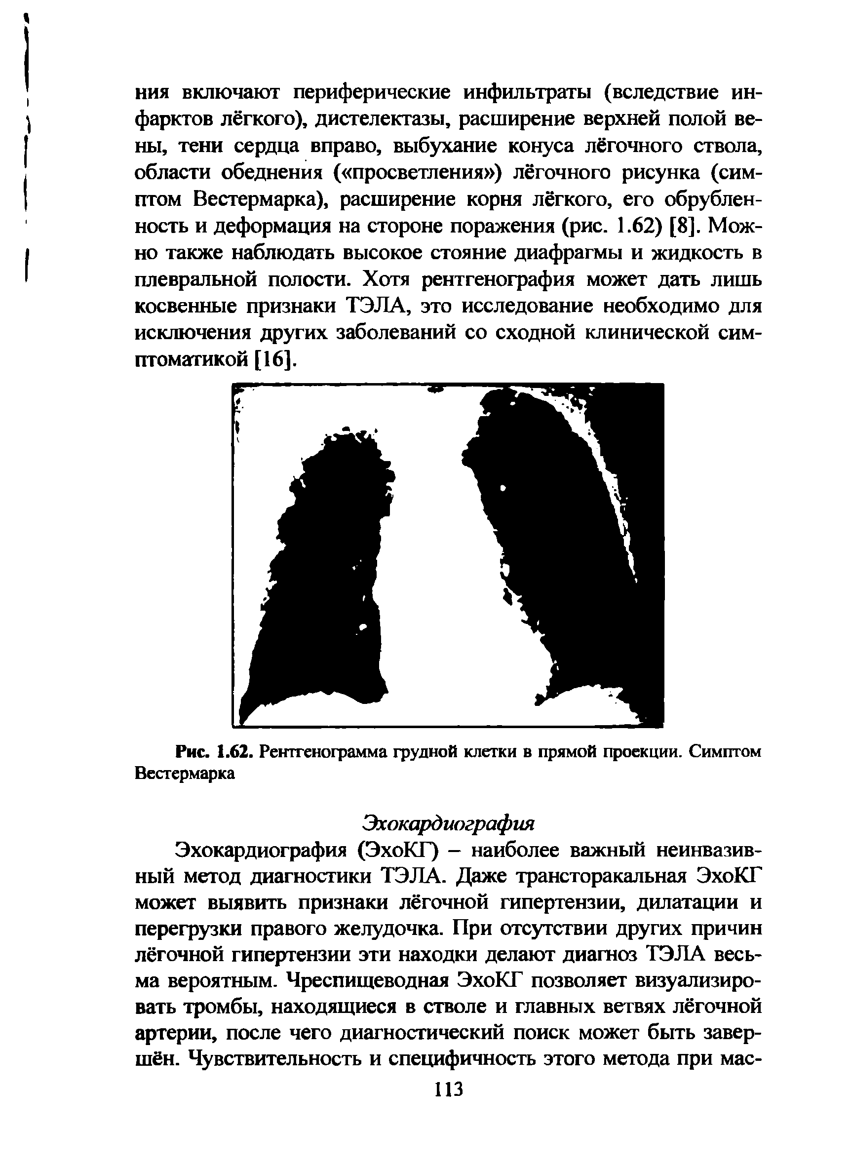 Рис. 1.62. Рентгенограмма грудной клетки в прямой проекции. Симптом Вестермарка...