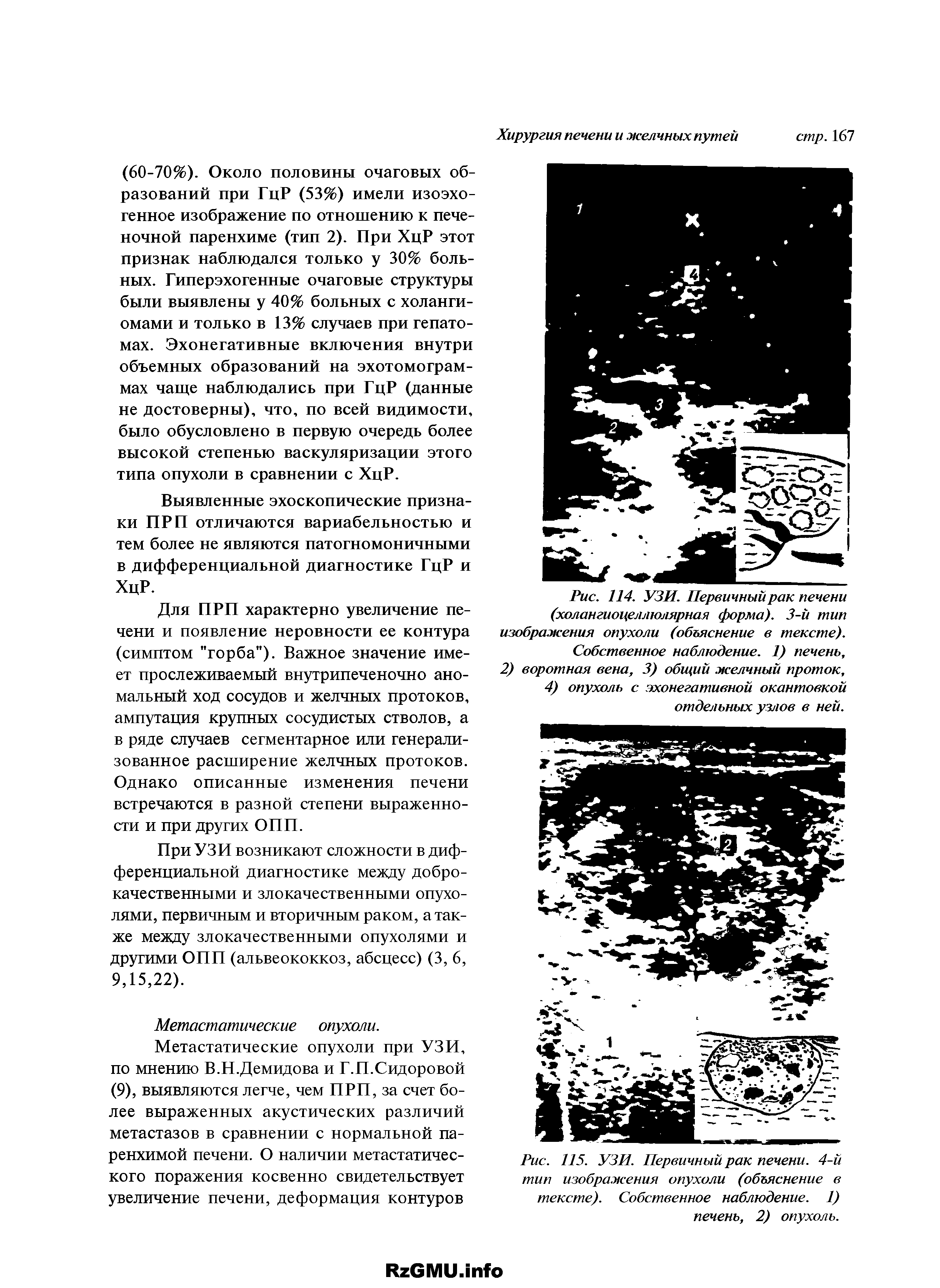 Рис. 114. УЗИ. Первичный рак печени (холангиоцеллюлярная форма). 3-й тип изображения опухоли (объяснение в тексте).