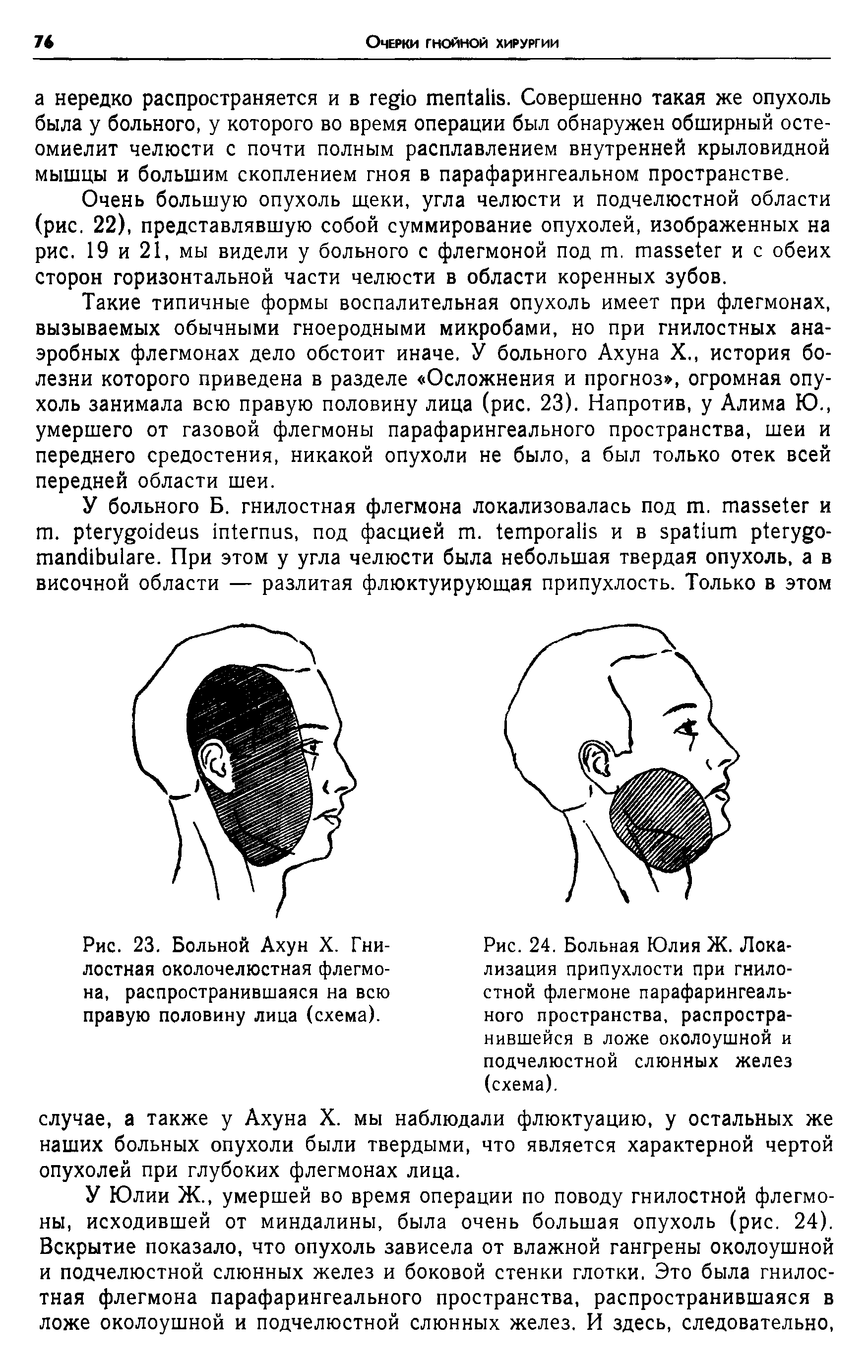 Рис. 24. Больная Юлия Ж. Локализация припухлости при гнилостной флегмоне парафарингеального пространства, распространившейся в ложе околоушной и подчелюстной слюнных желез (схема).