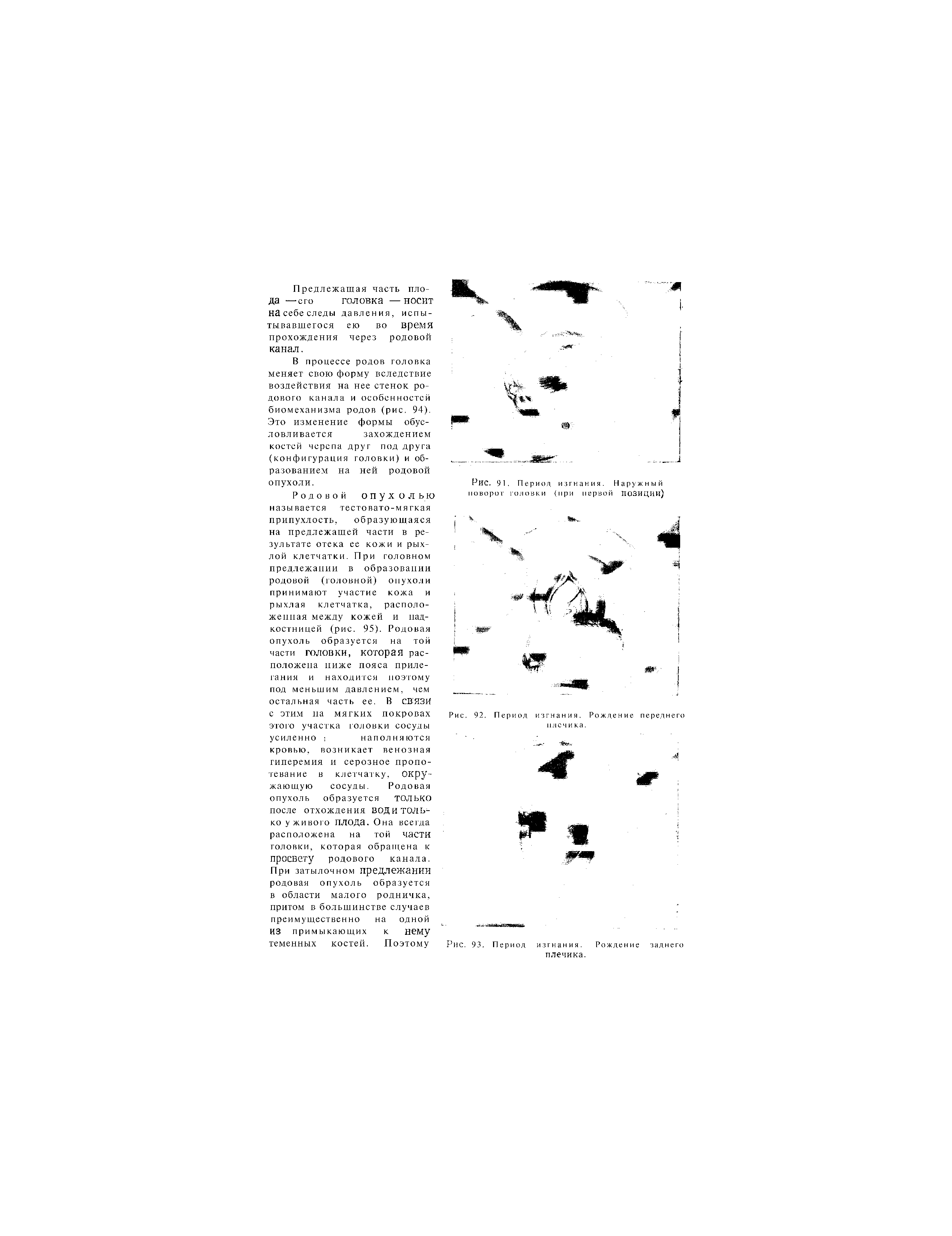 Рис. 91. Период изгнания. Наружный поворот головки (при первой ПОЗИЦИИ)...