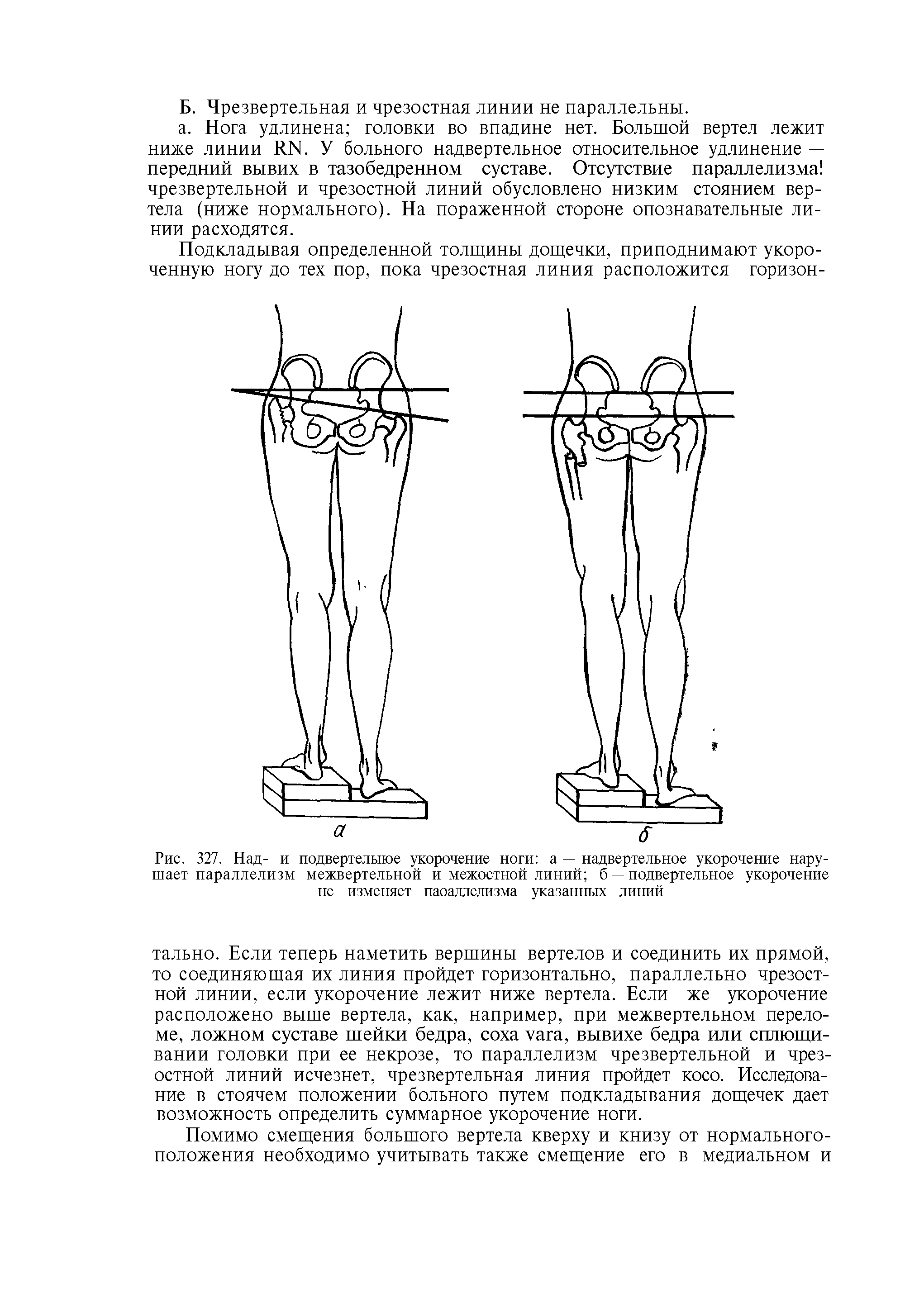 Рис. 327. Над- и подвертелыюе укорочение ноги а — надвертельное укорочение нарушает параллелизм межвертельной и межостной линий б — подвертельное укорочение не изменяет паоаллелизма указанных линий...