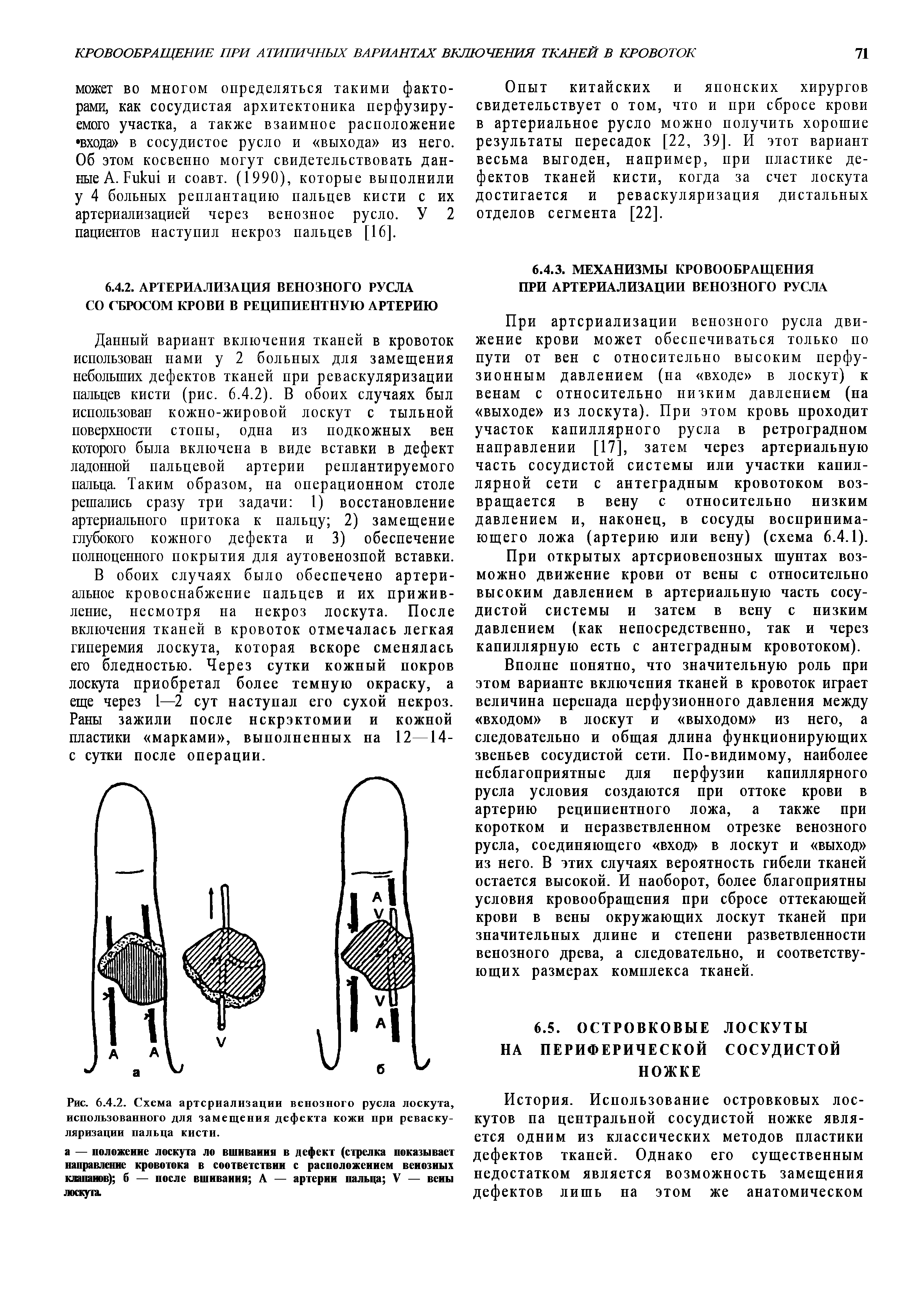 Рис. 6.4.2. Схема артсриализации венозного русла лоскута, использованного для замещения дефекта кожи при реваскуляризации пальца кисти.