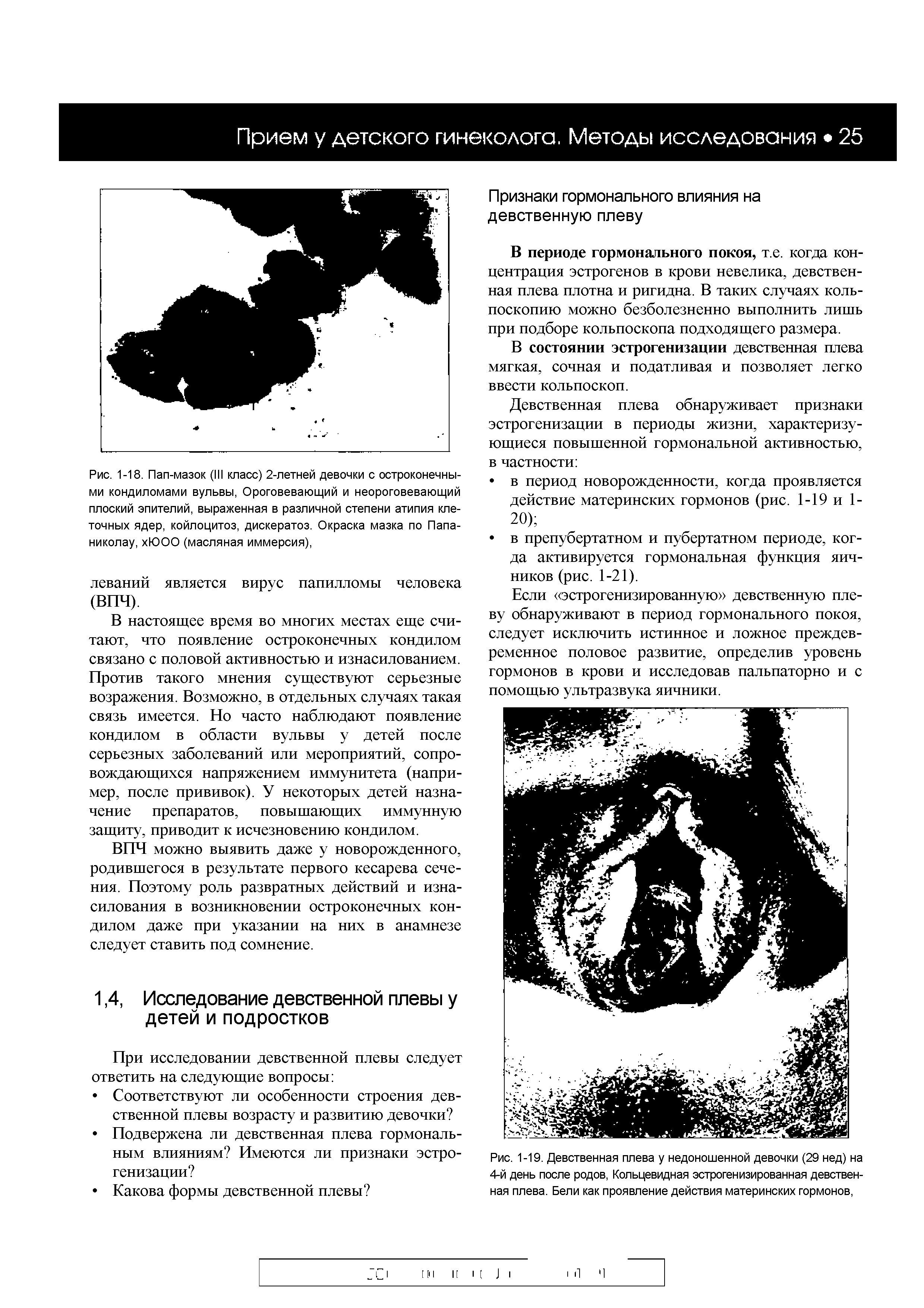 Рис. 1-18. Пап-мазок (III класс) 2-летней девочки с остроконечными кондиломами вульвы, Ороговевающий и неороговевающий плоский эпителий, выраженная в различной степени атипия клеточных ядер, койлоцитоз, дискератоз. Окраска мазка по Папа-николау, хЮОО (масляная иммерсия),...