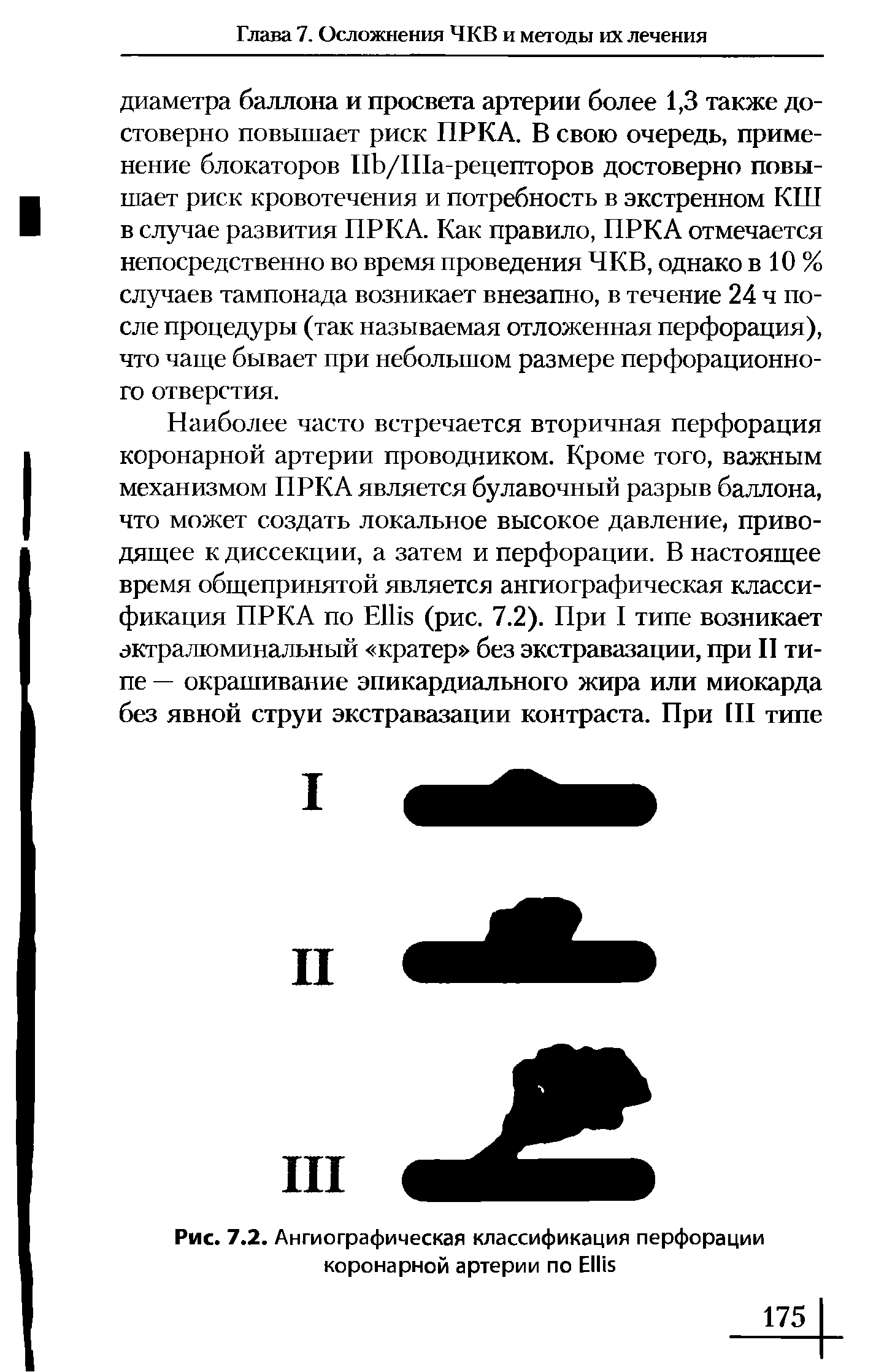 Рис. 7.2. Ангиографическая классификация перфорации коронарной артерии по E ...