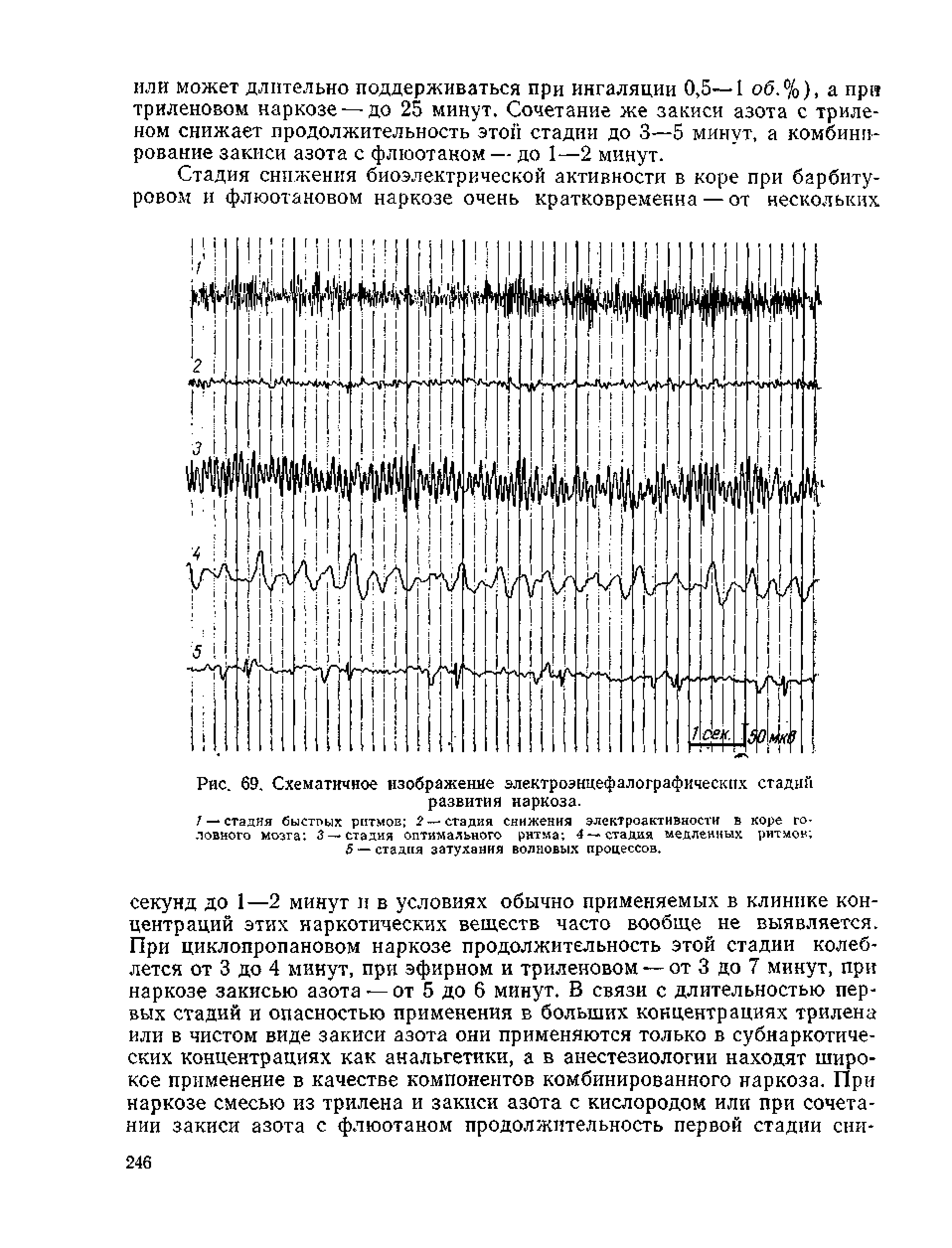 Рис. 69. Схематичное изображение электроэнцефалографических стадий развития наркоза.