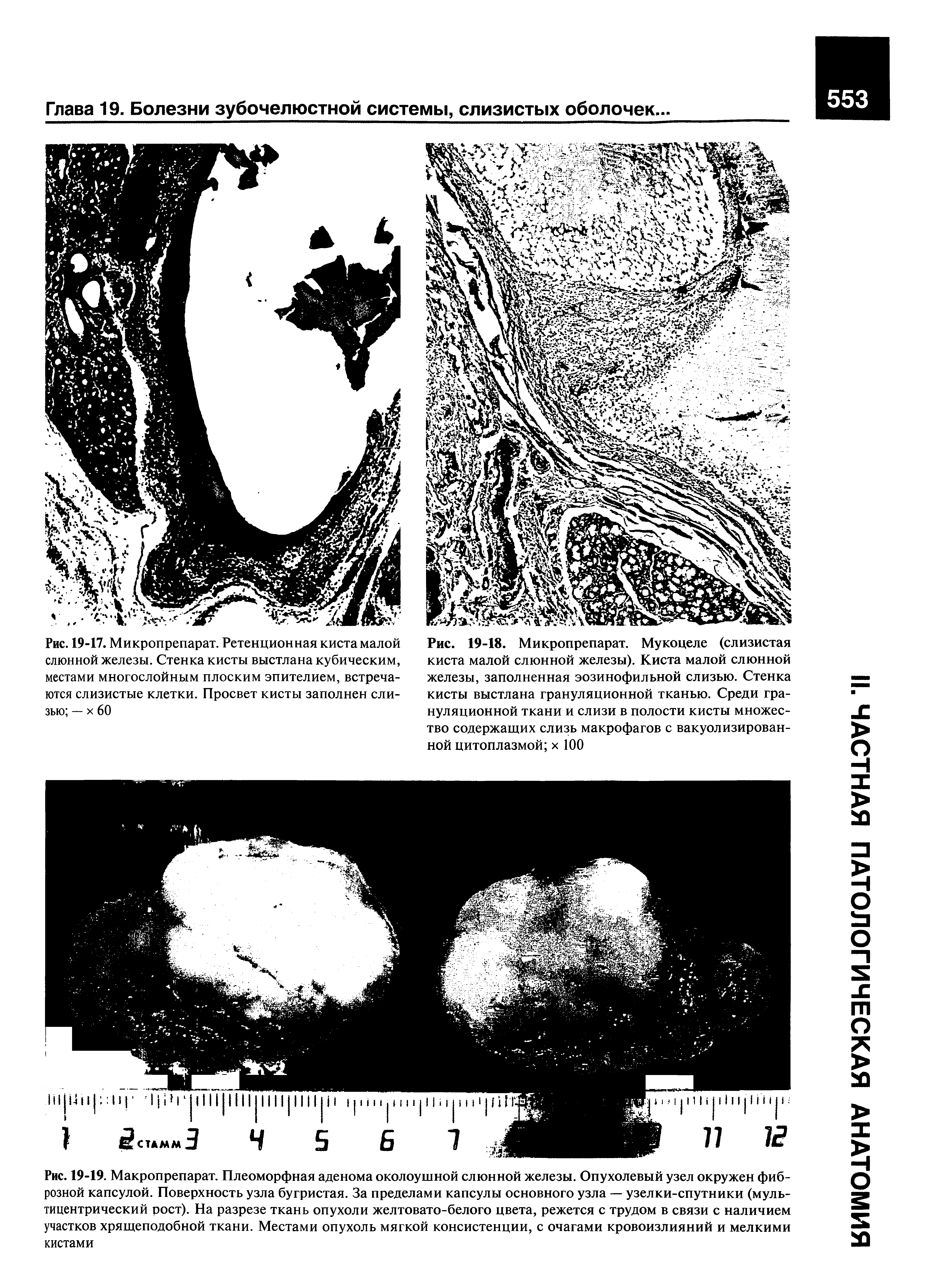 Рис. 19-17. Микропрепарат. Ретенционная киста малой слюнной железы. Стенка кисты выстлана кубическим, местами многослойным плоским эпителием, встречаются слизистые клетки. Просвет кисты заполнен слизью — х 60...