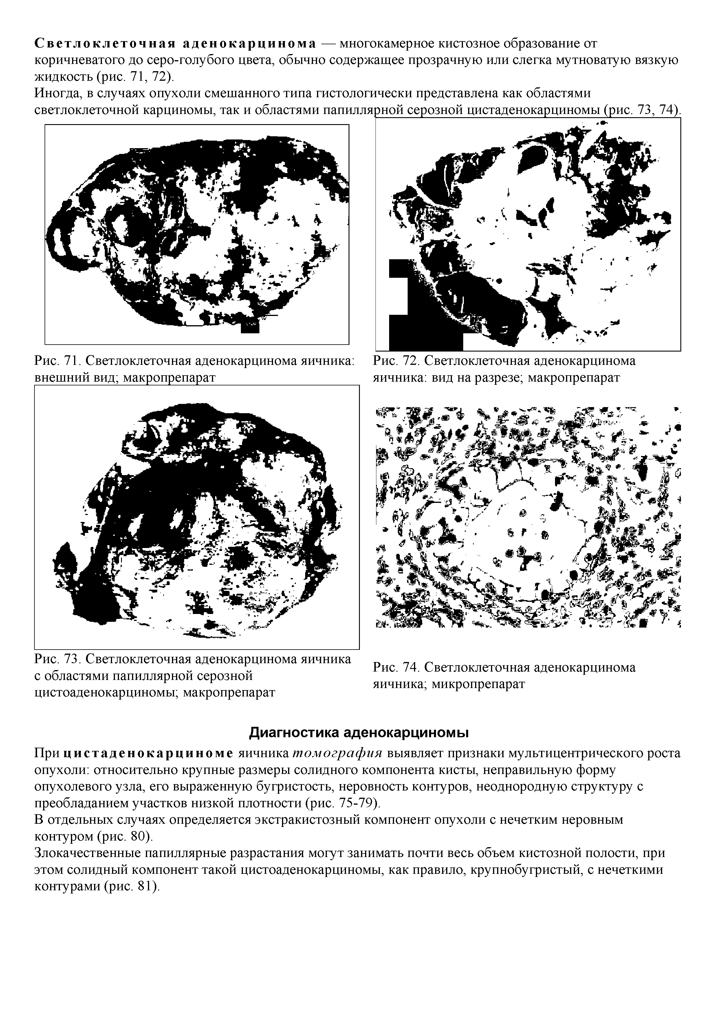 Рис. 73. Светлоклеточная аденокарцинома яичника с областями папиллярной серозной...
