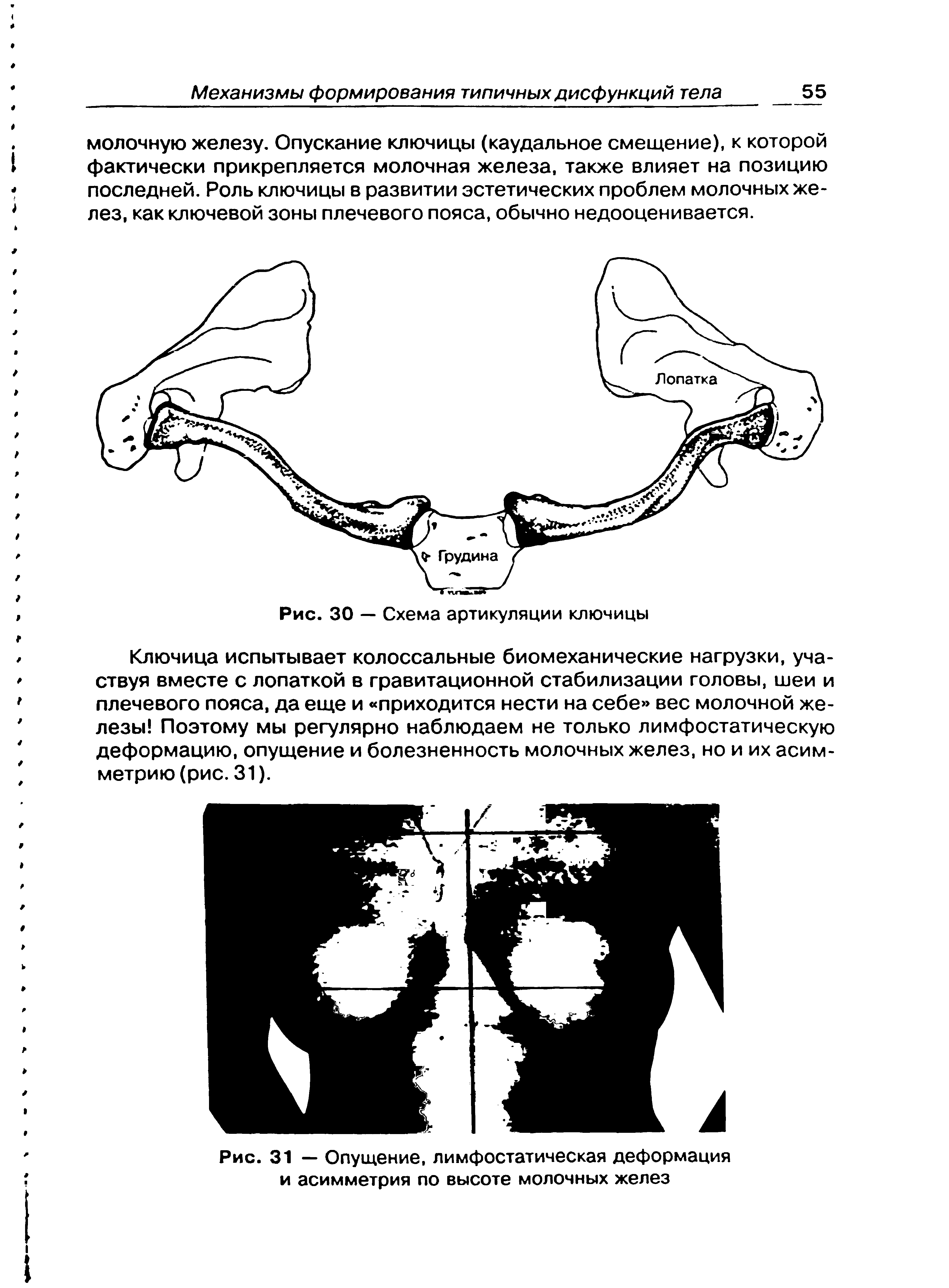 Рис. 31 — Опущение, лимфостатическая деформация и асимметрия по высоте молочных желез...