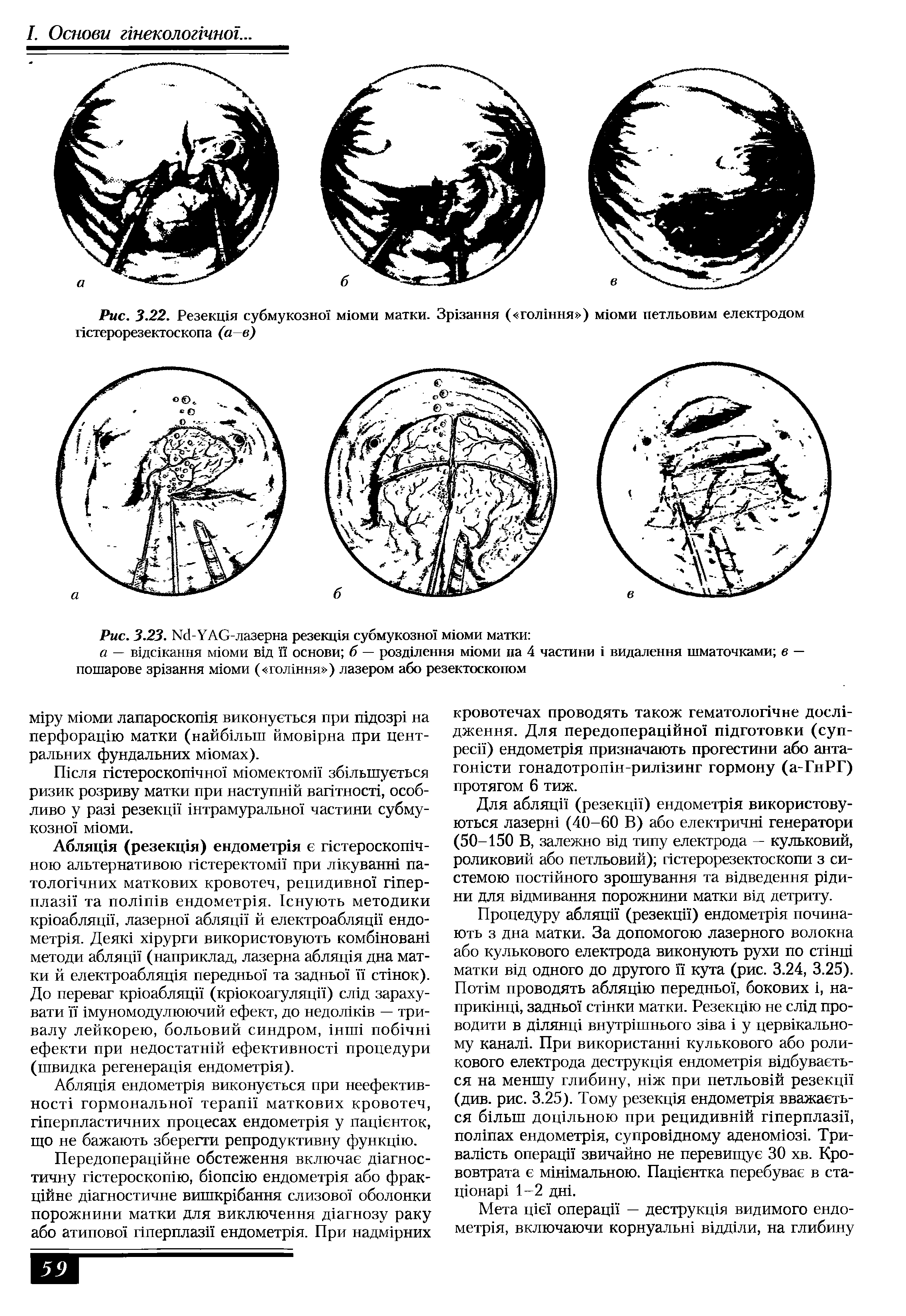 Рис. 3.22. Резекщя субмукозноТ мюми матки. Зр зання ( голшня ) мюми петльовим електродом пстерорезектоскопа (а в)...