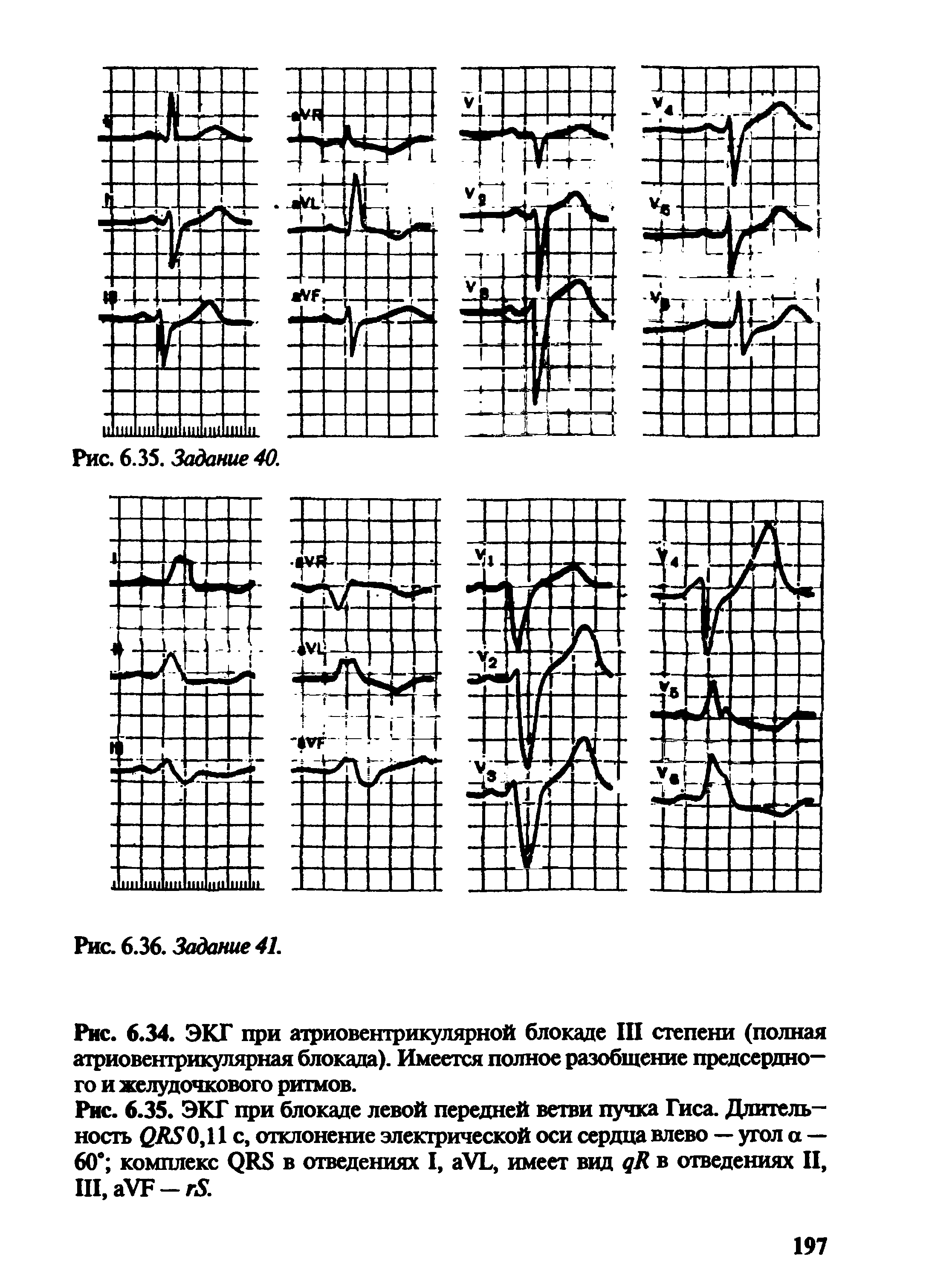 Рис. 6.35. ЭКГ при блокаде левой передней ветви пучка Гиса. Длительность 0,11 с, отклонение электрической оси сердца влево — угол а —...