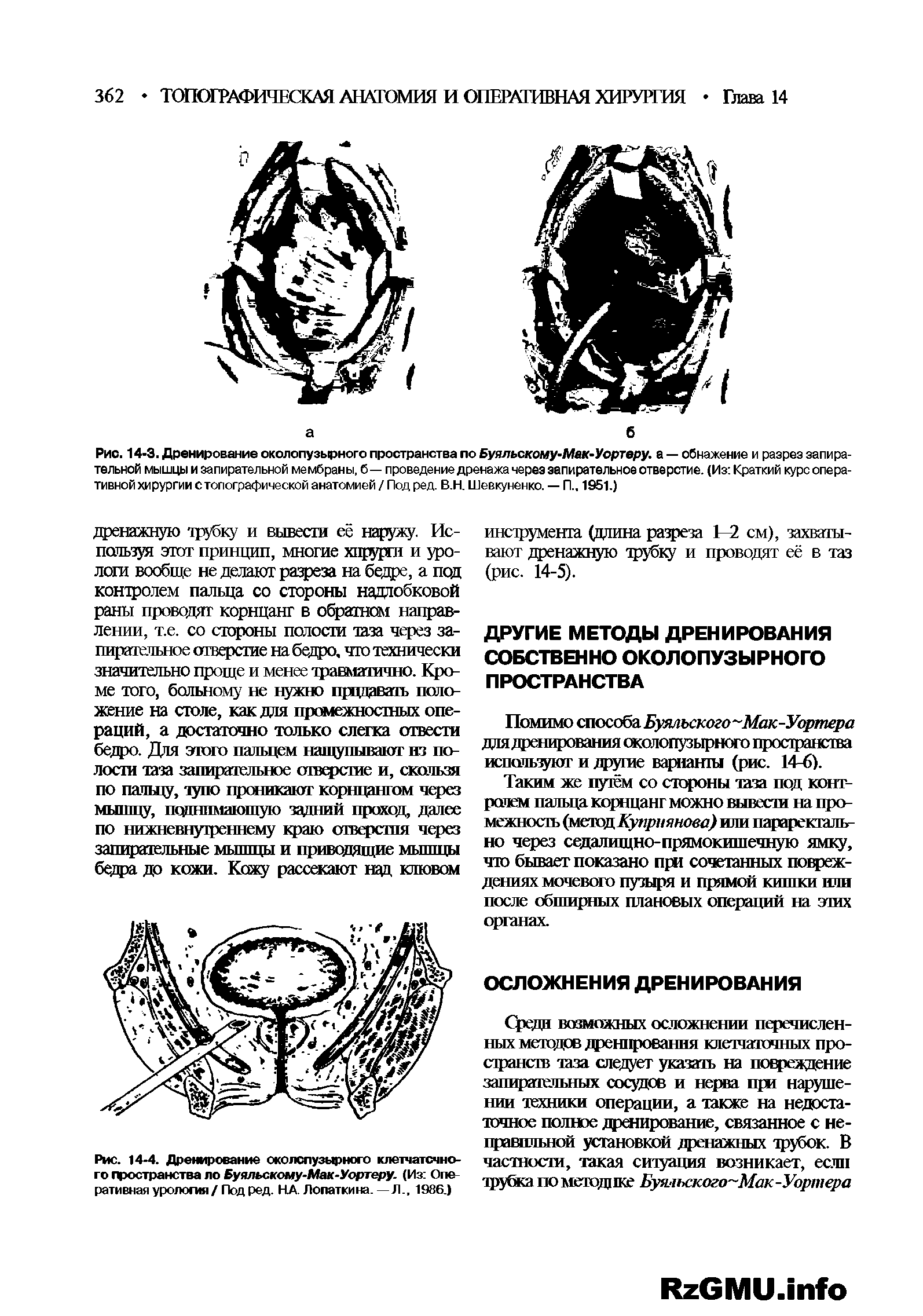Рис. 14-3. Дренирование околопузырного пространства по Буяльскому-Мак-Уортеру. а — обнажение и разрез запирательной мышцы и запирательной мембраны, б— проведение дренажа через запирательное отверстие. (Из Краткий курс оперативной хирургии стопографической анатомией / Под ред. В.Н. Шевкуненко. — П., 1951.)...