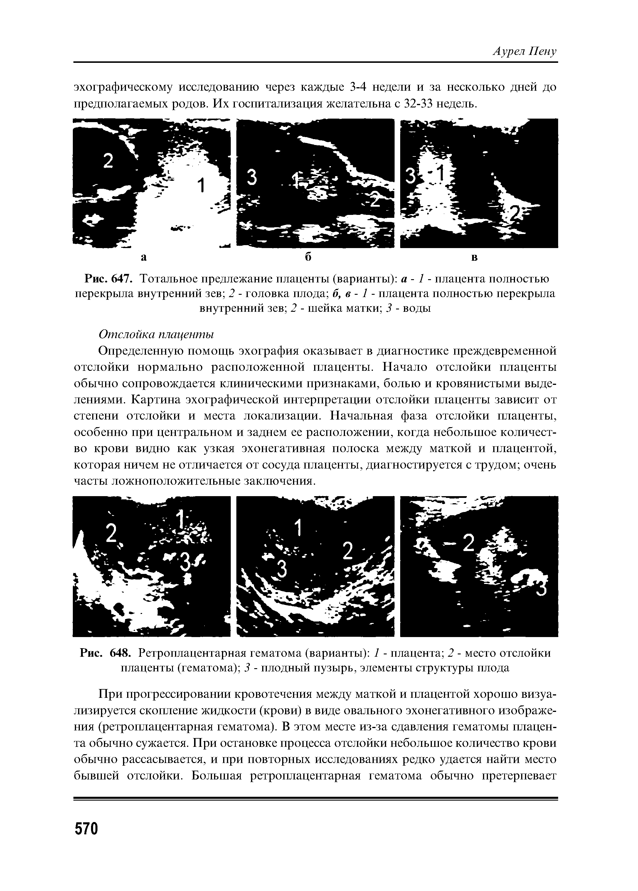 Рис. 648. Ретроплацентарная гематома (варианты) 1 - плацента 2 - место отслойки плаценты (гематома) 3 - плодный пузырь, элементы структуры плода...