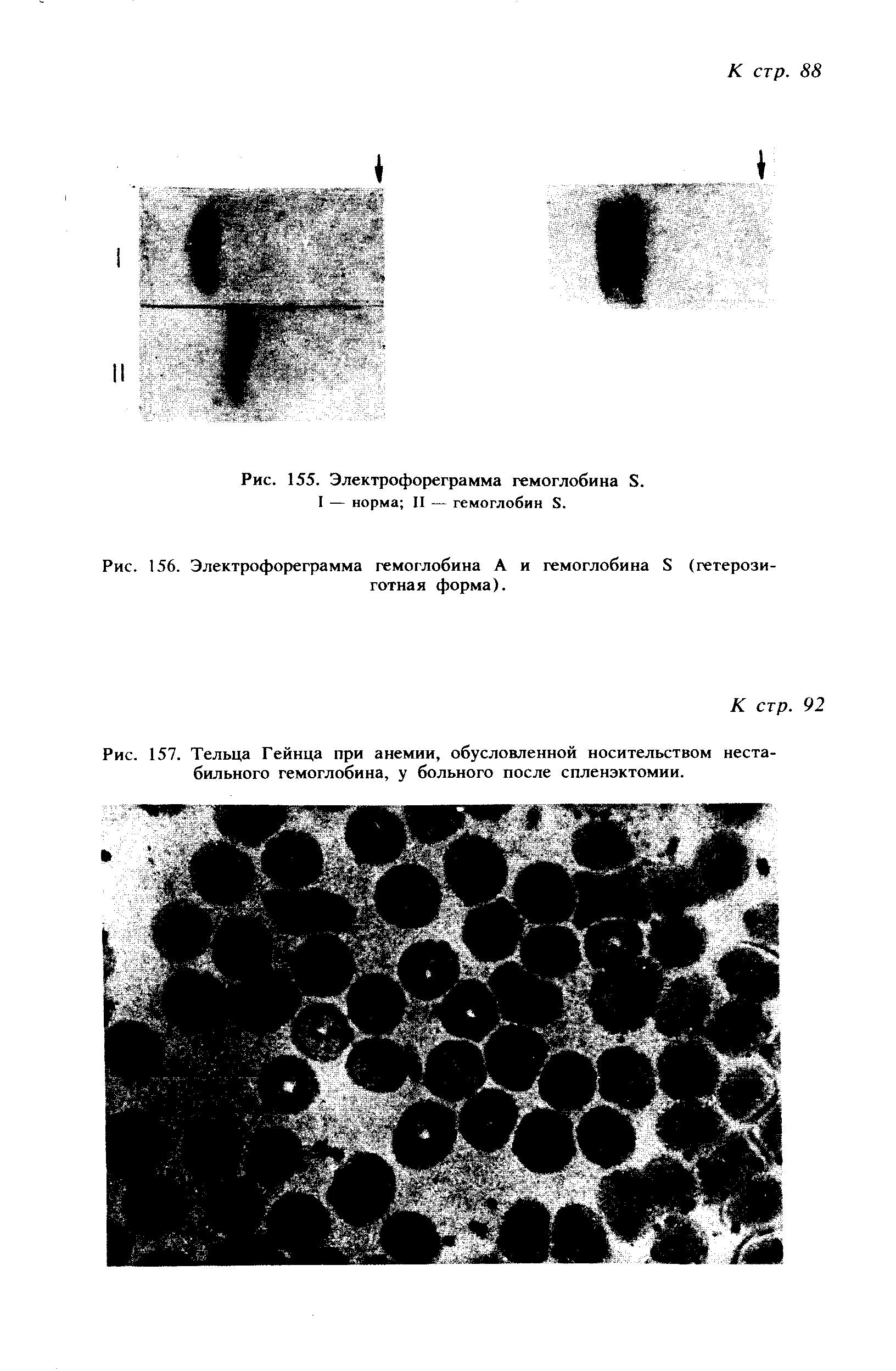 Рис. 157. Тельца Гейнца при анемии, обусловленной носительством нестабильного гемоглобина, у больного после спленэктомии.