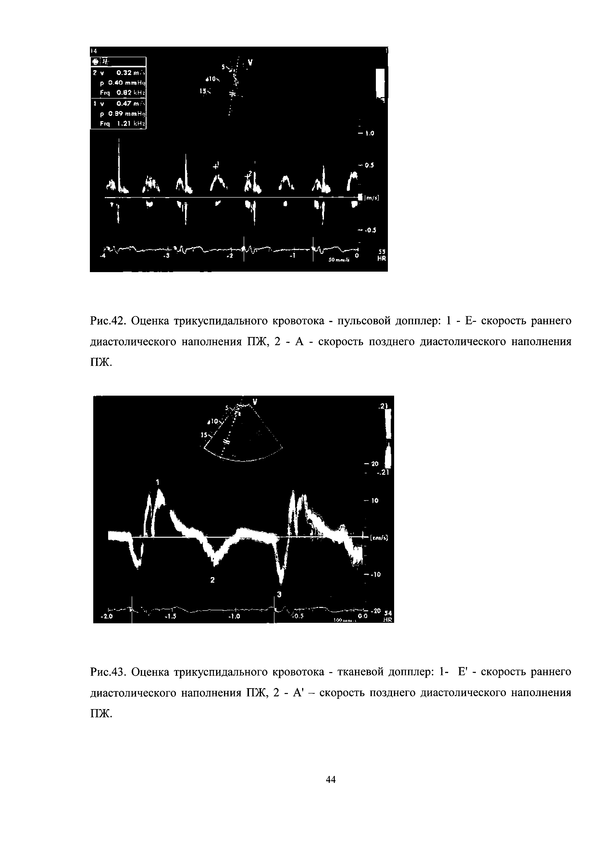 Рис.43. Оценка трикуспидального кровотока - тканевой допплер 1- Е - скорость раннего диастолического наполнения ПЖ, 2 - А - скорость позднего диастолического наполнения ПЖ.