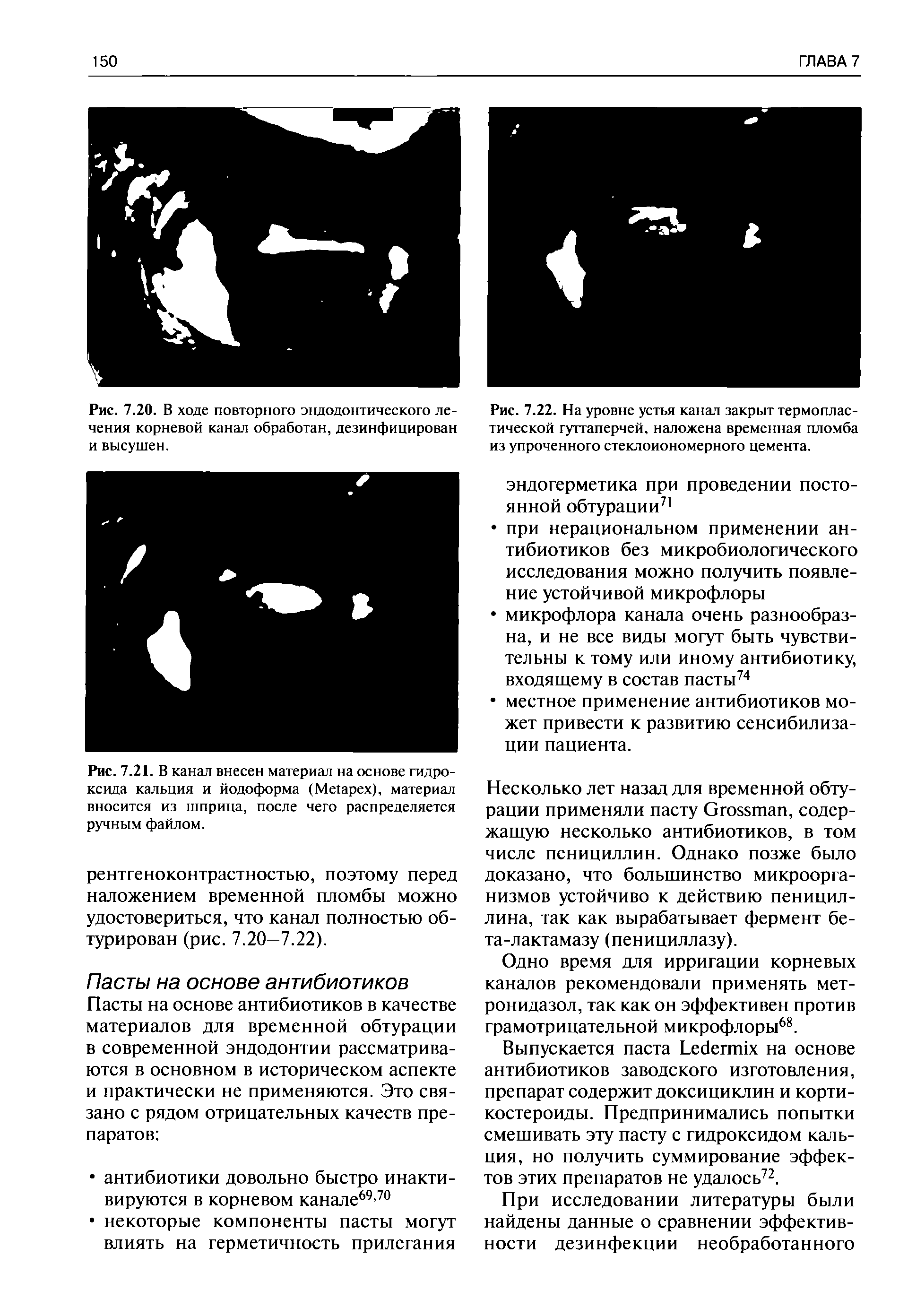 Рис. 7.22. На уровне устья канал закрыт термопластической гуттаперчей, наложена временная пломба из упроченного стеклоиономерного цемента.
