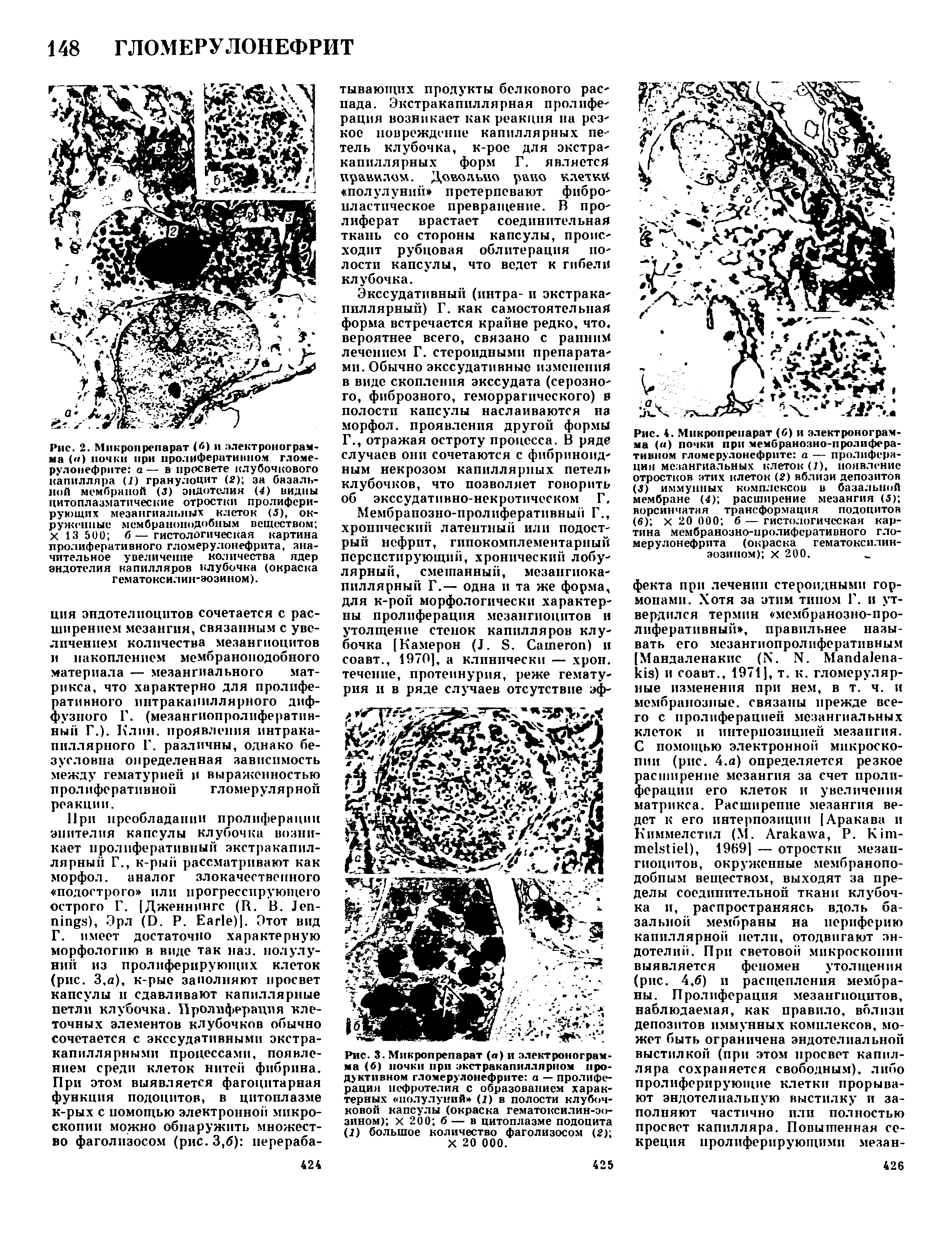 Рис. 2. Микропрепарат (б) и электрон о грамма (< ) почки при пролиферативном гломерулонефрите а — в просвете клубочкового капилляра (I) гранулоцит (2) за базальной мембраной (J) эндотелия (4) видны цитоплазматические отростки пролиферирующих мезангиальных клеток (5), окруженные мембранонодобным веществом X 13 500 6—гистологическая картина...