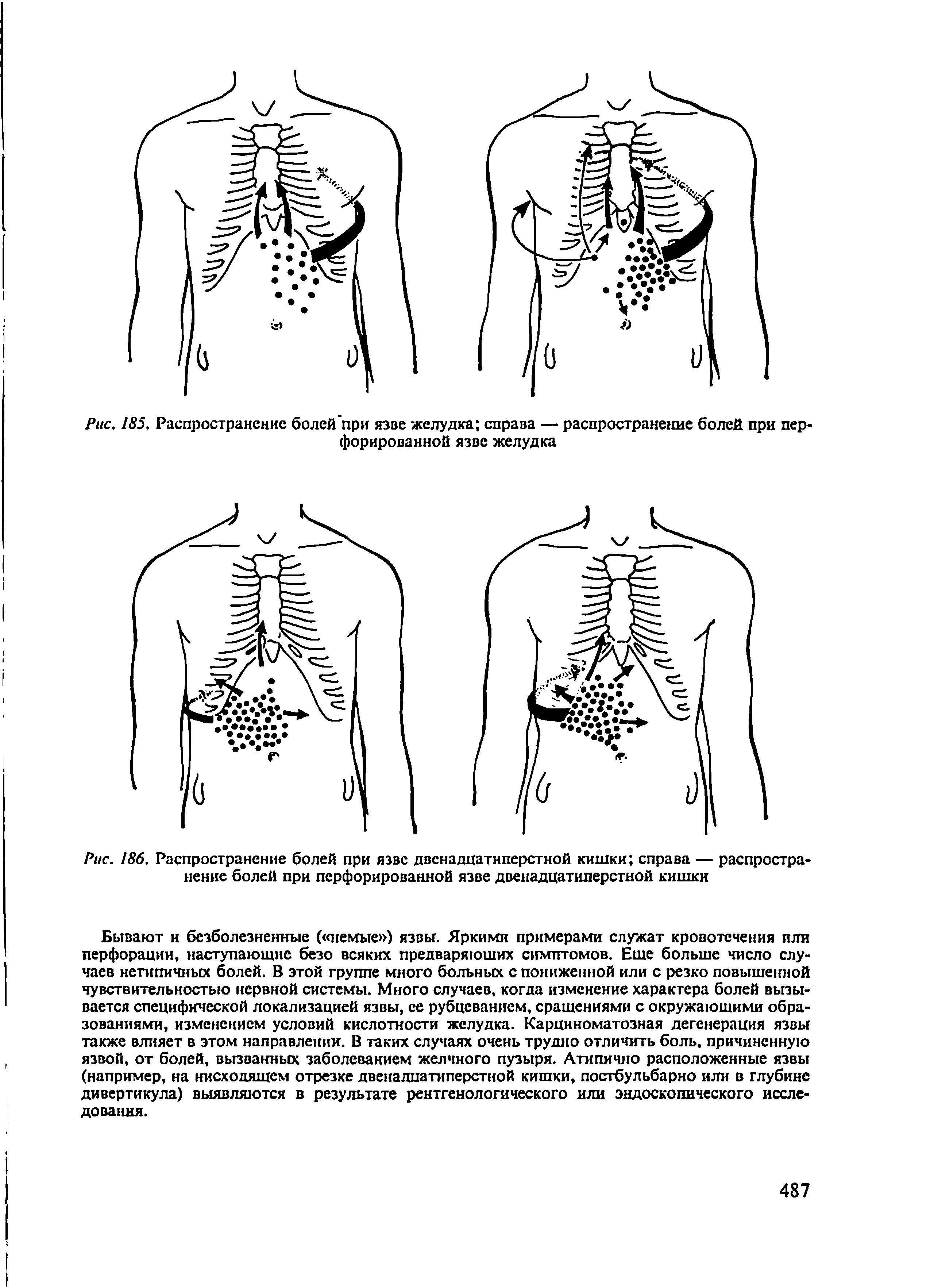 Рис. 186. Распространение болей при язве двенадцатиперстной кишки справа — распространение болей при перфорированной язве двенадцатиперстной кишки...