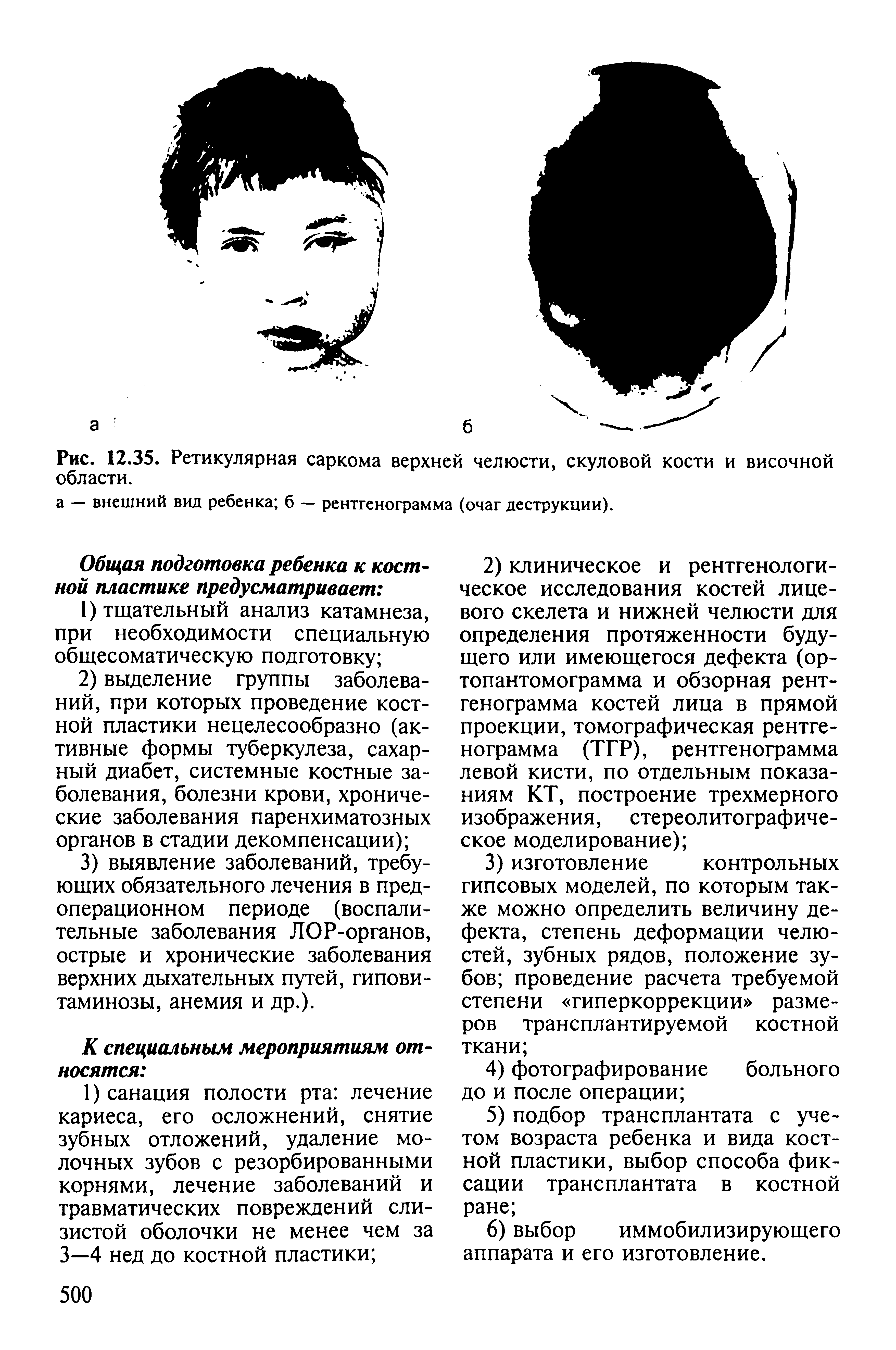 Рис. 12.35. Ретикулярная саркома верхней челюсти, скуловой кости и височной области.