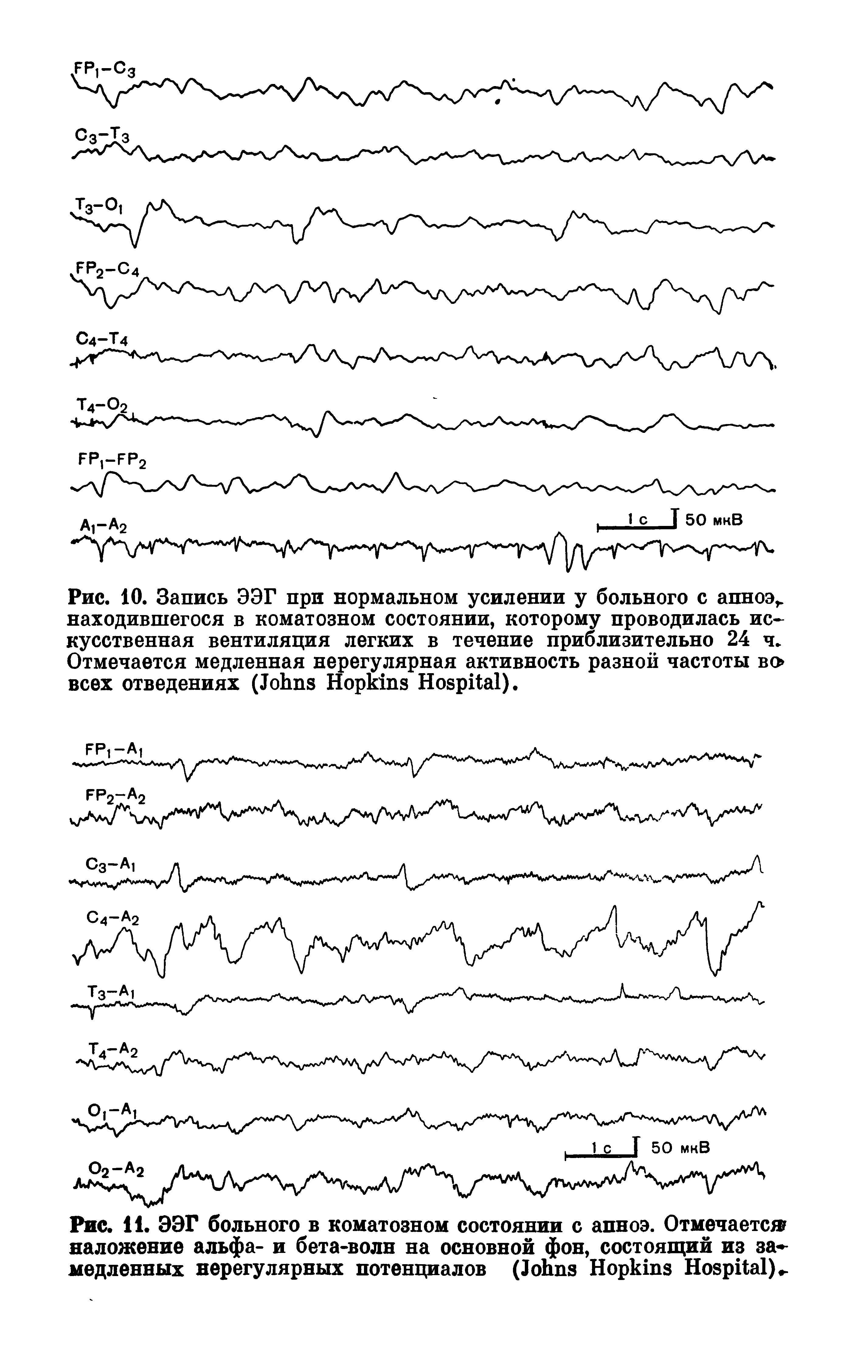 Рис. 11. ЭЭГ больного в коматозном состоянии с апноэ. Отмечается наложение альфа- и бета-волн на основной фон, состоящий из за медленных нерегулярных потенциалов (J H H ) .